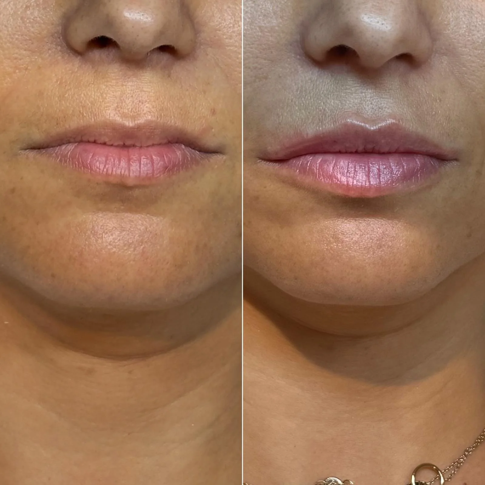Close-up comparison of a person's lips before and after cosmetic lip treatment, showing fuller, smoother lips with a natural pink tint on the right.
