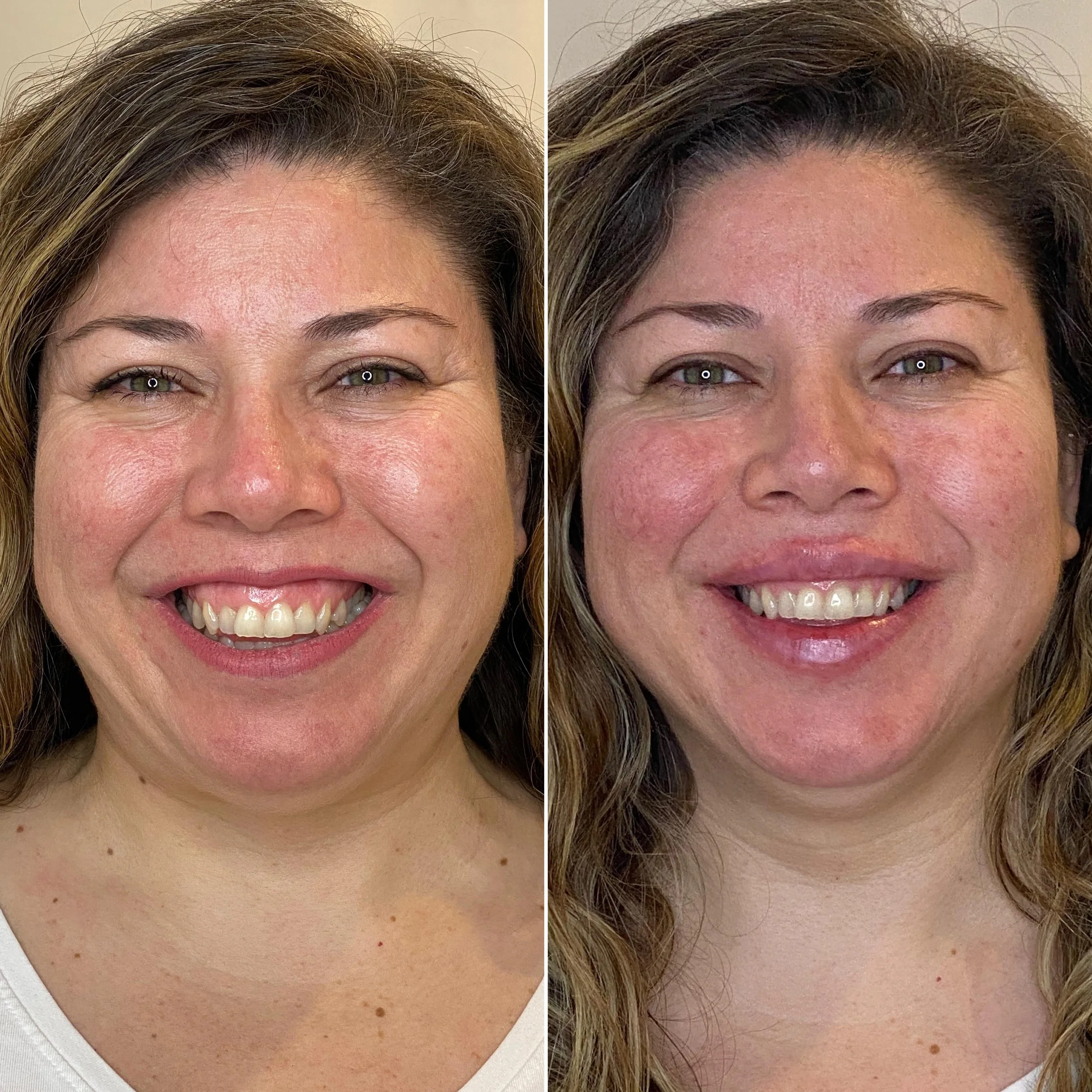 Before and after images of a woman smiling, showing improvement in skin texture and appearance.