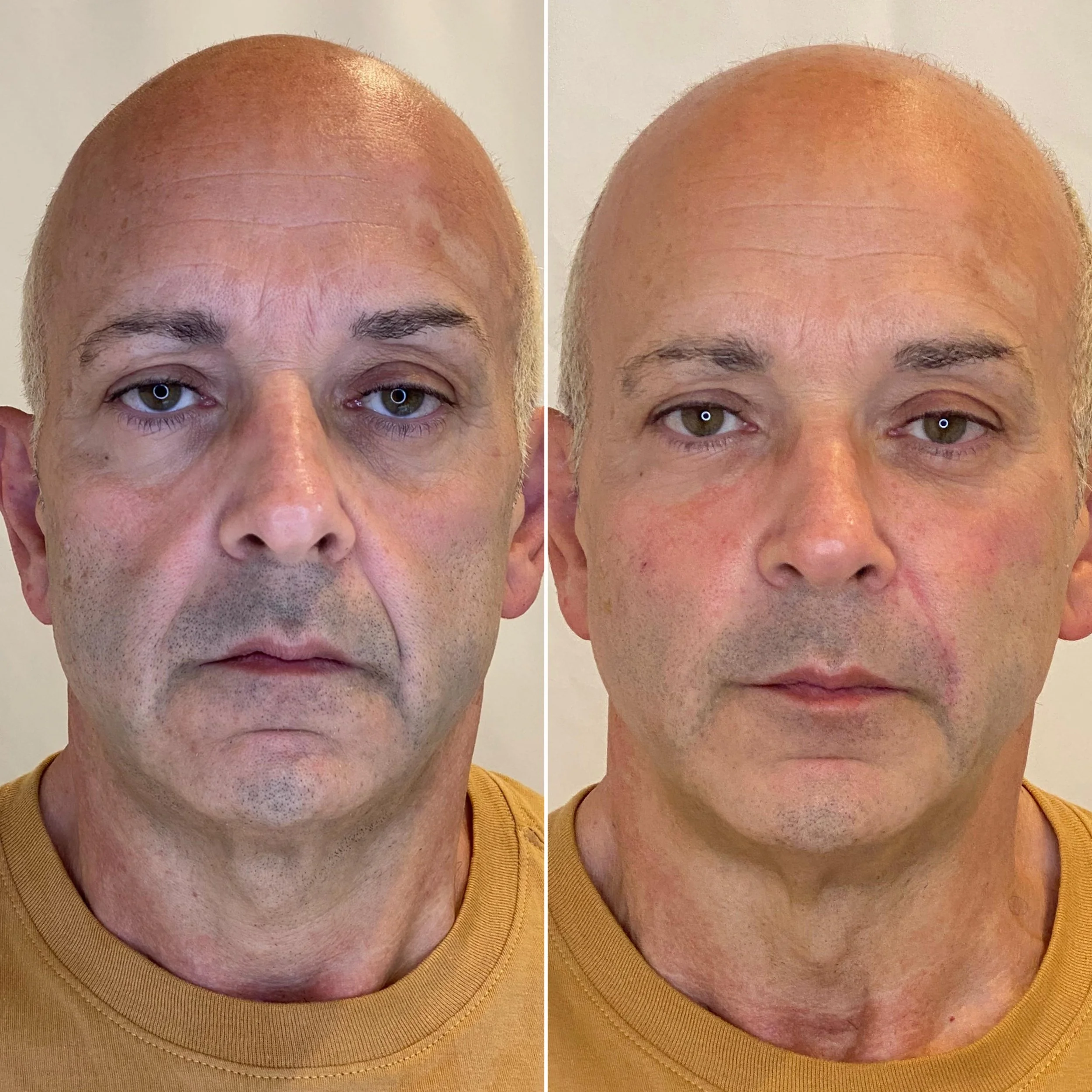 Side-by-side comparison of a man before and after cosmetic facial treatment, showing improved skin tone and reduced signs of aging.