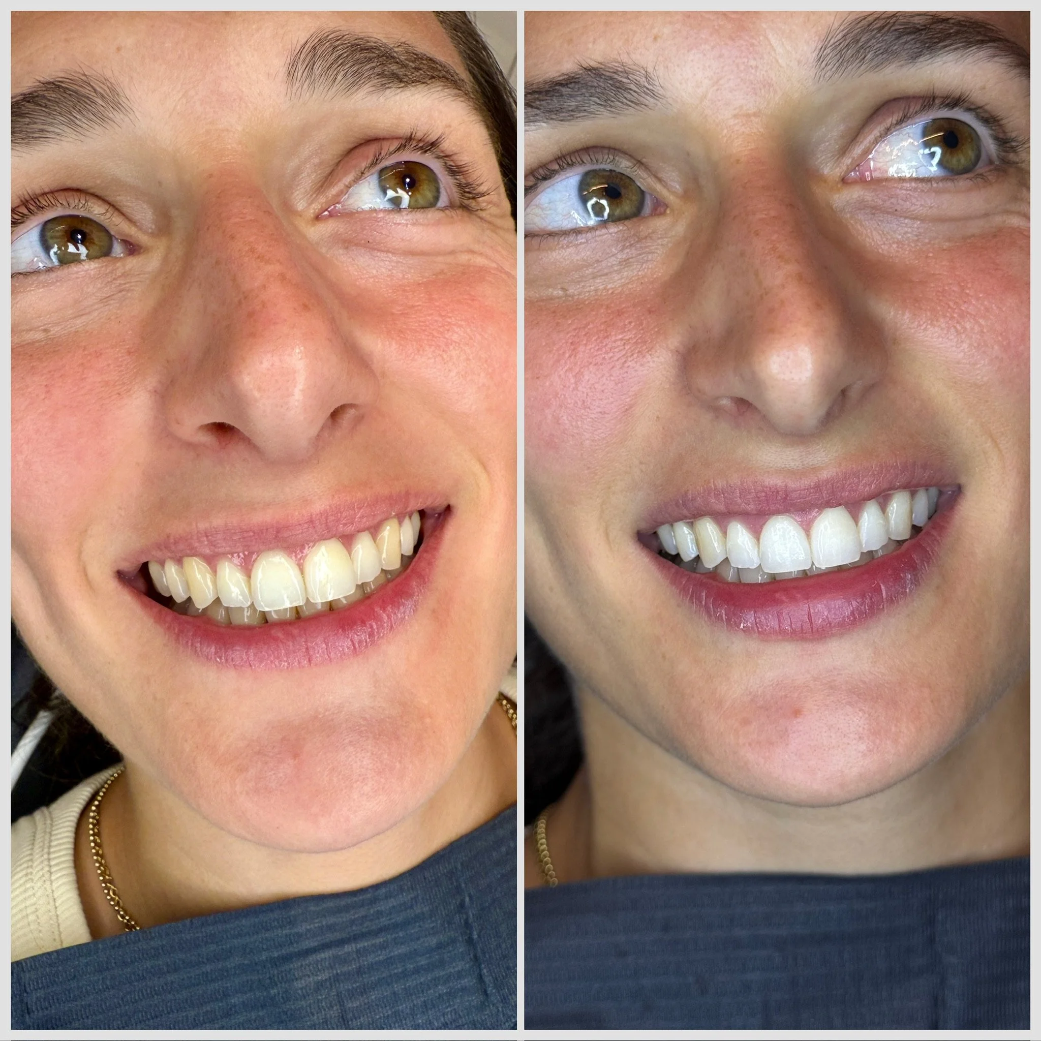 Close-up of a woman's smiling face, showing her teeth before and after dental whitening treatment.