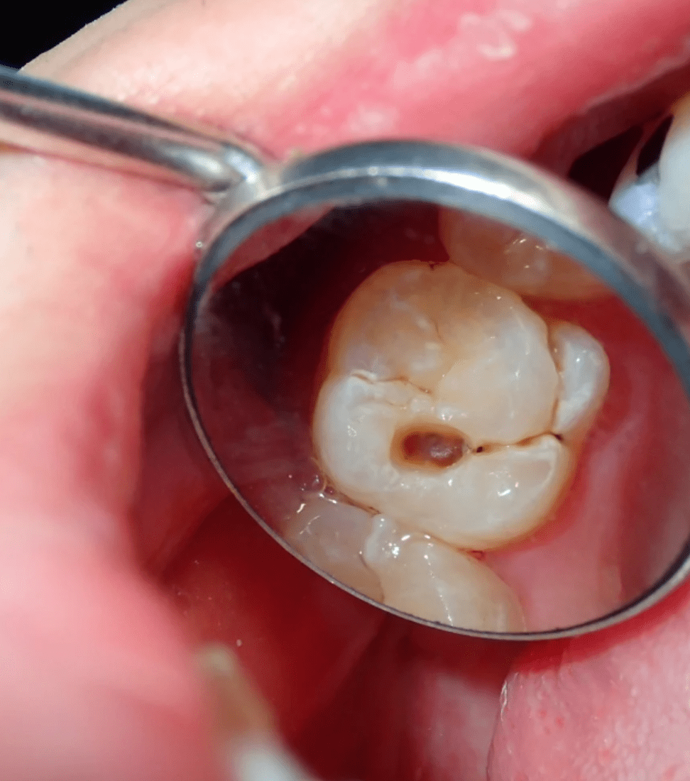 Cavities  and Tooth Decay | Cape Town 