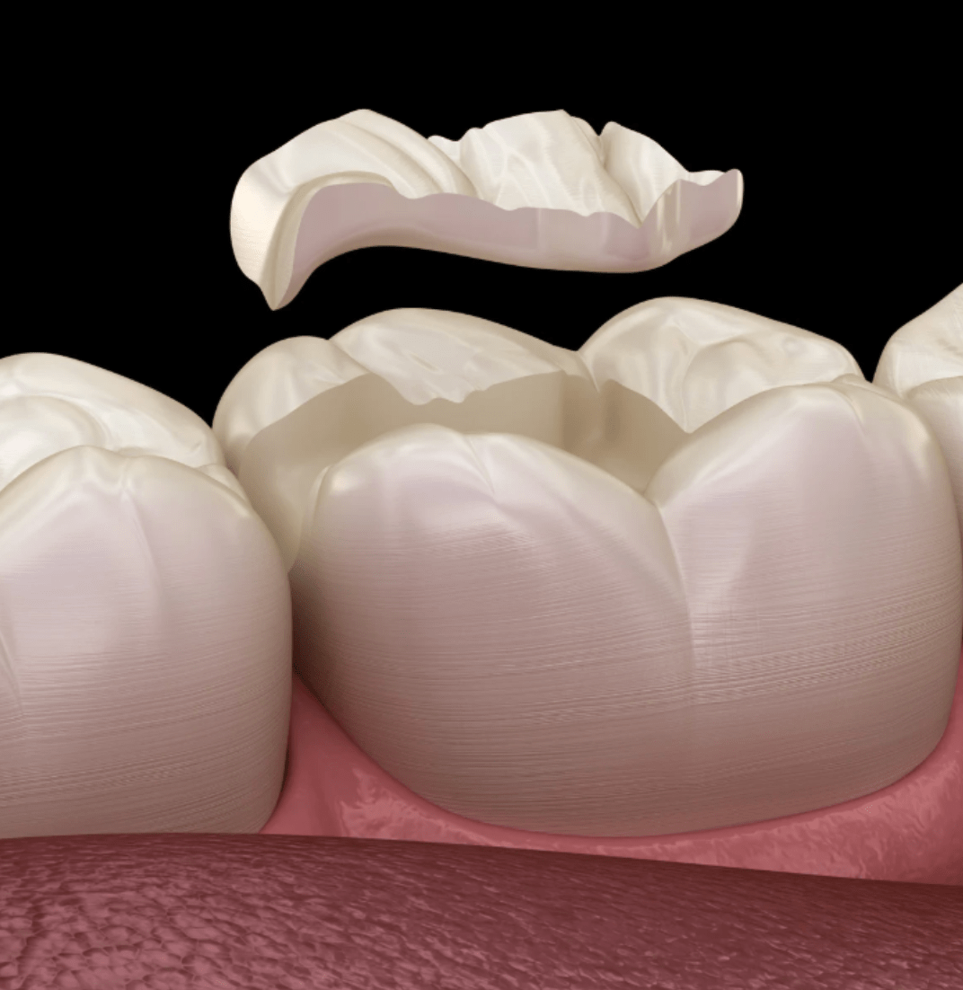 Inlays &amp; Onlays | Cape Town 