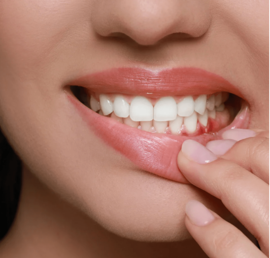 Gum Disease | Cape Town