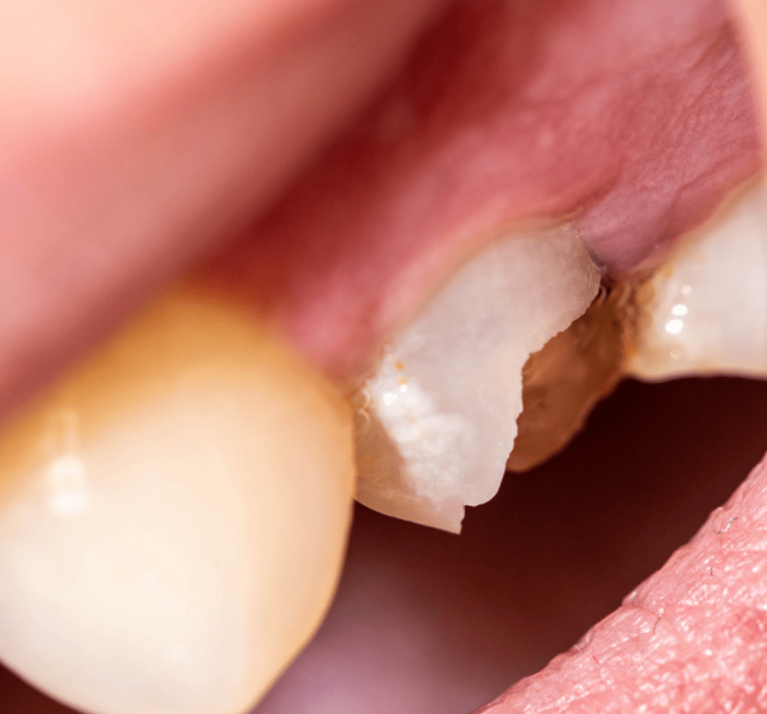 Chipped Tooth | Cape Town 