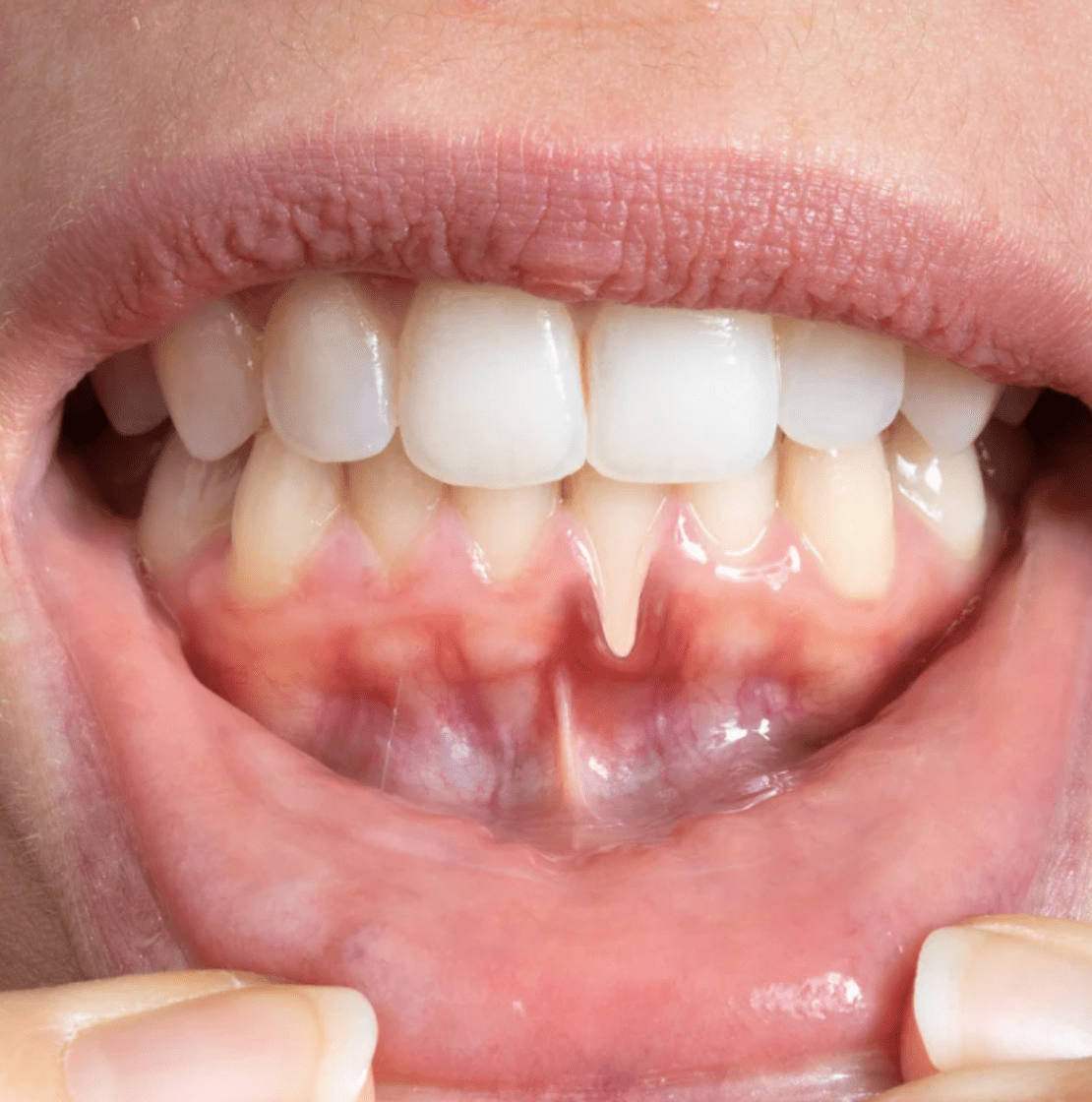 Gum Depigmentation   | Cape Town