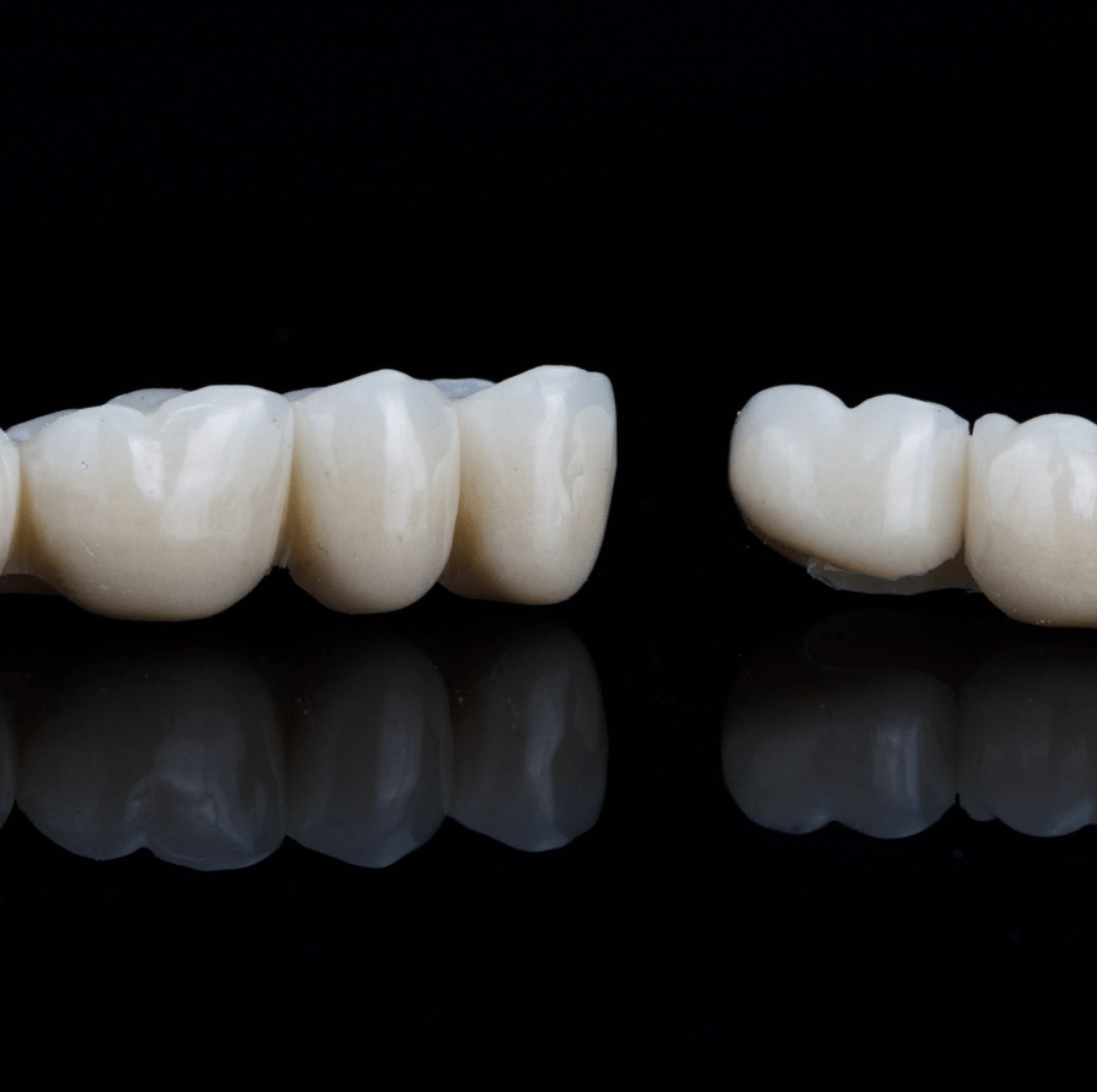 Crowns &amp; Bridges | Cape Town 