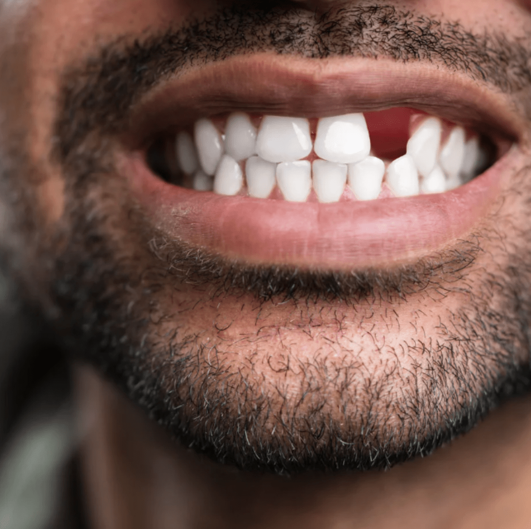 Missing Teeth | Cape Town 