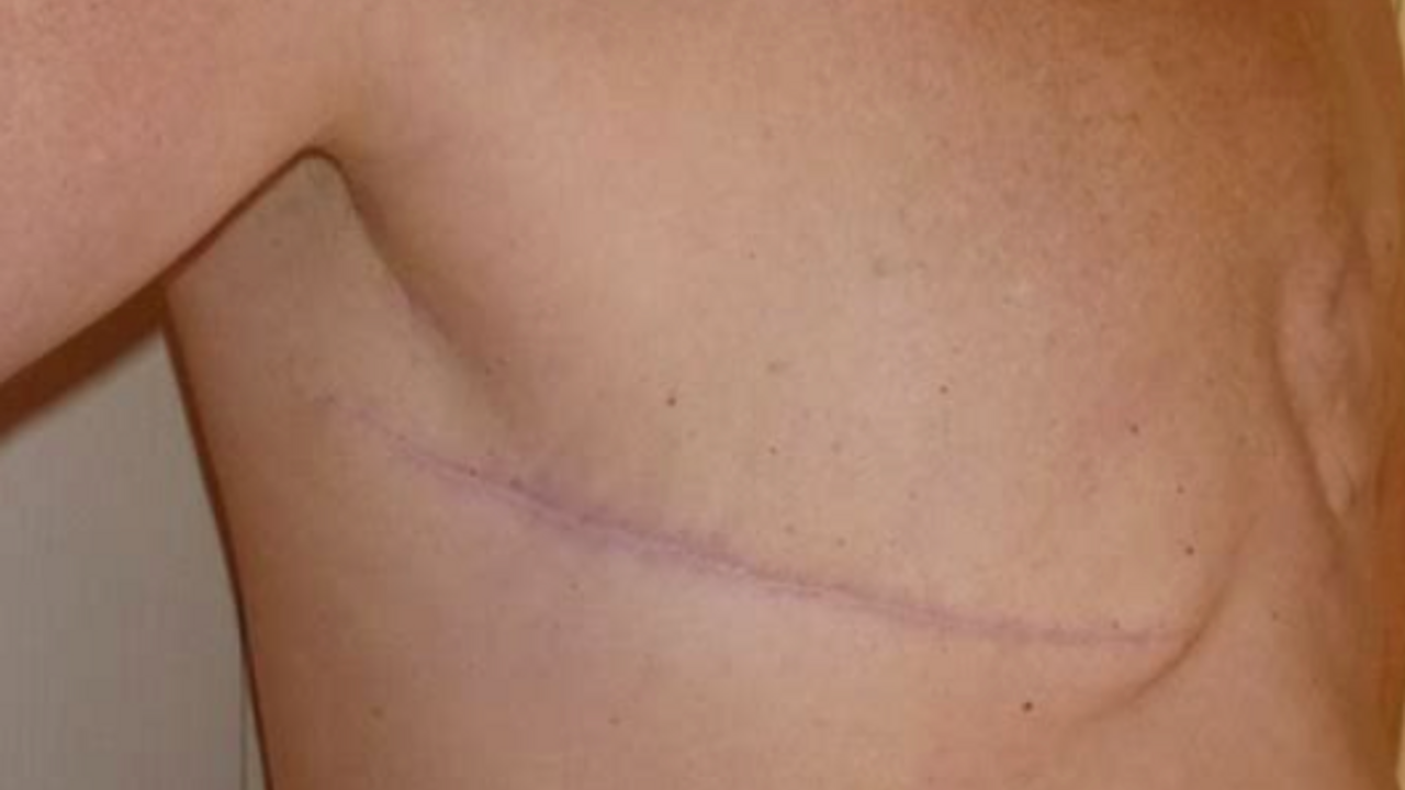 post mastectomy.png