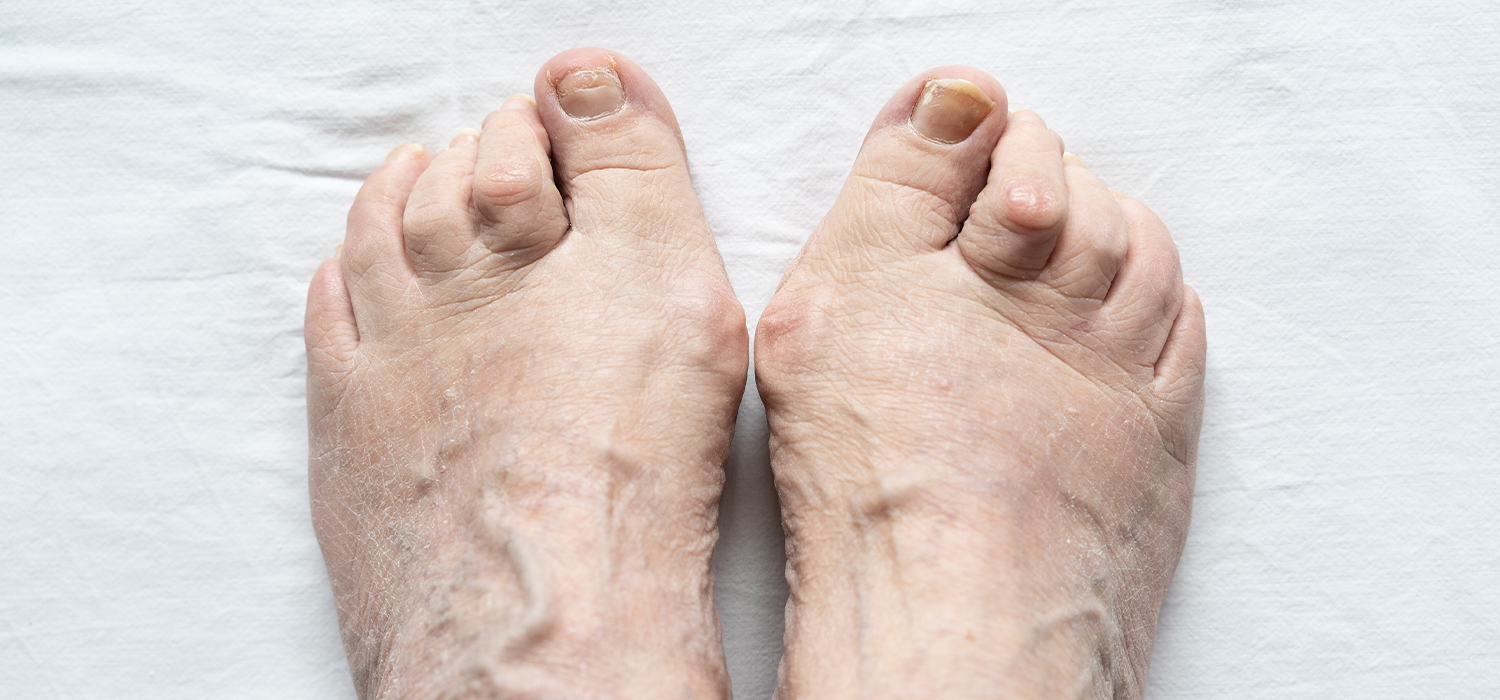 Close-up of elderly person's feet with bunions and dry skin on a white textured surface.