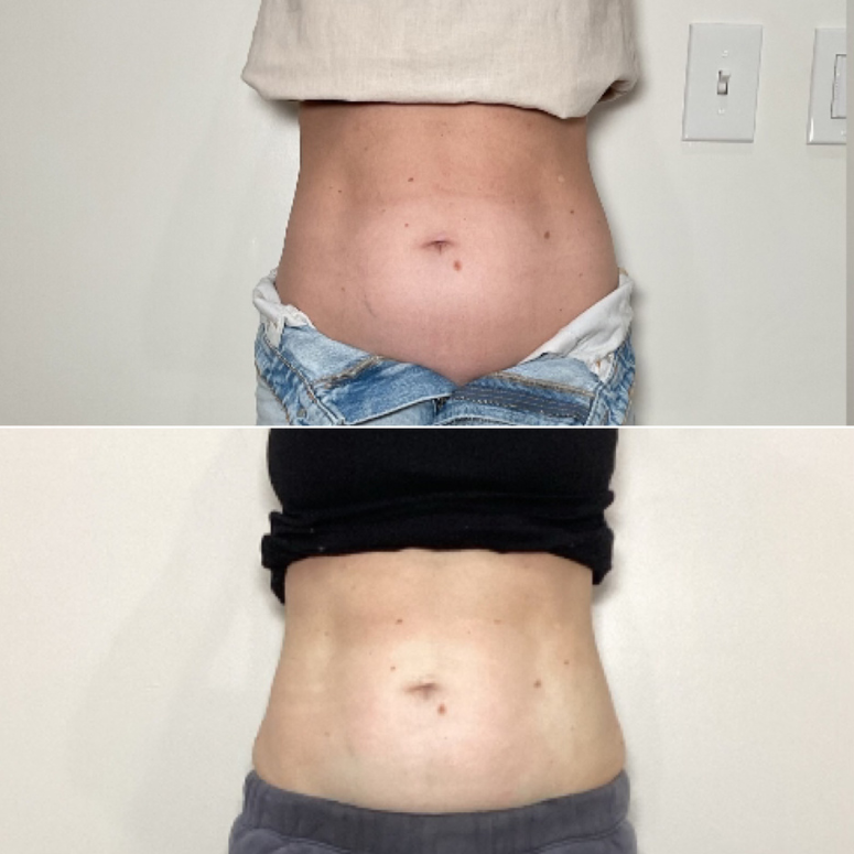 TruSolace_Body Contouring_Before_After_4.png