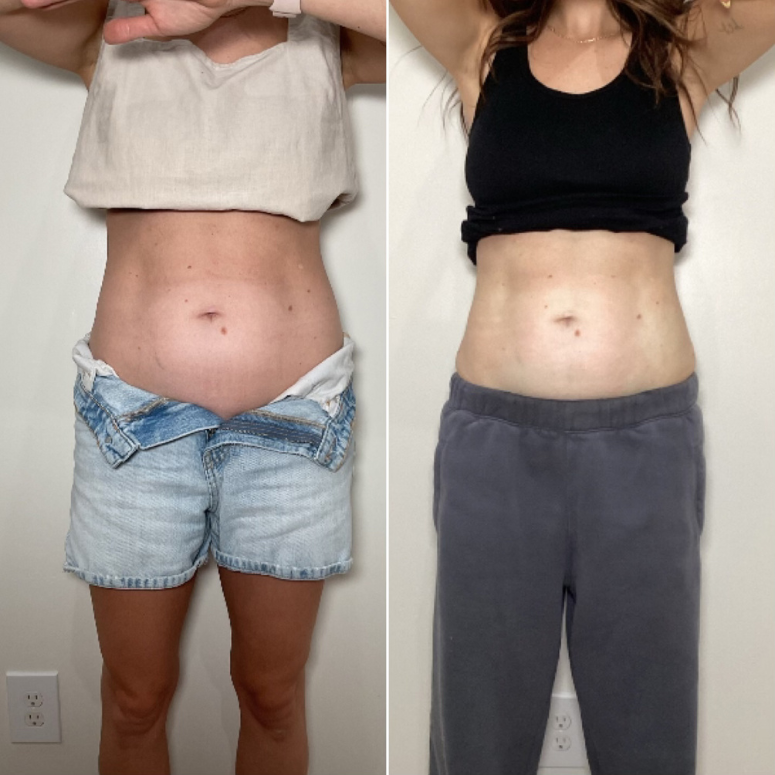 TruSolace_Body Contouring_Before_After_6.png