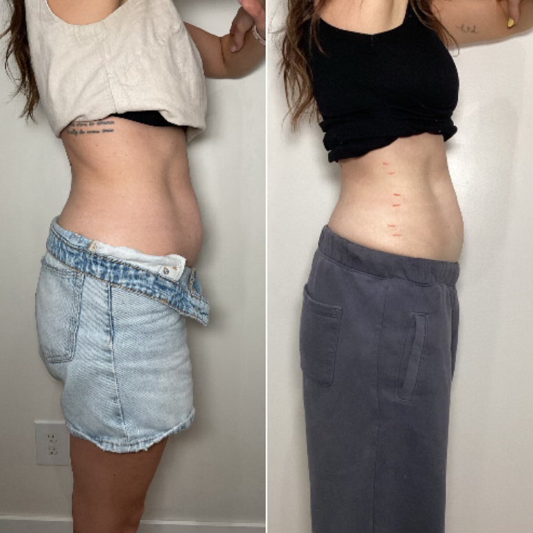 TruSolace_Body Contouring_Before_After_3.png