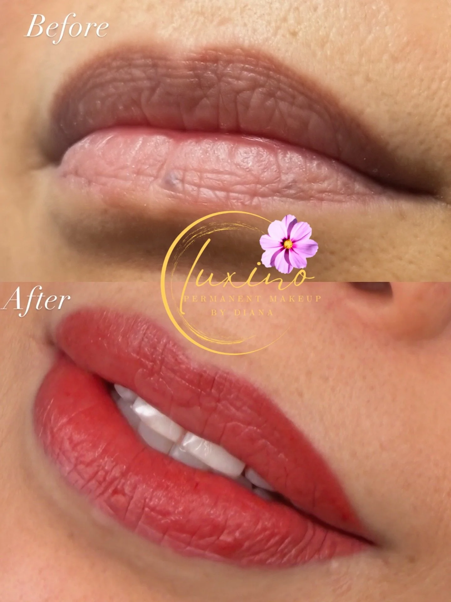 Comparison of lips before and after a cosmetic procedure, showing pigmentation change.