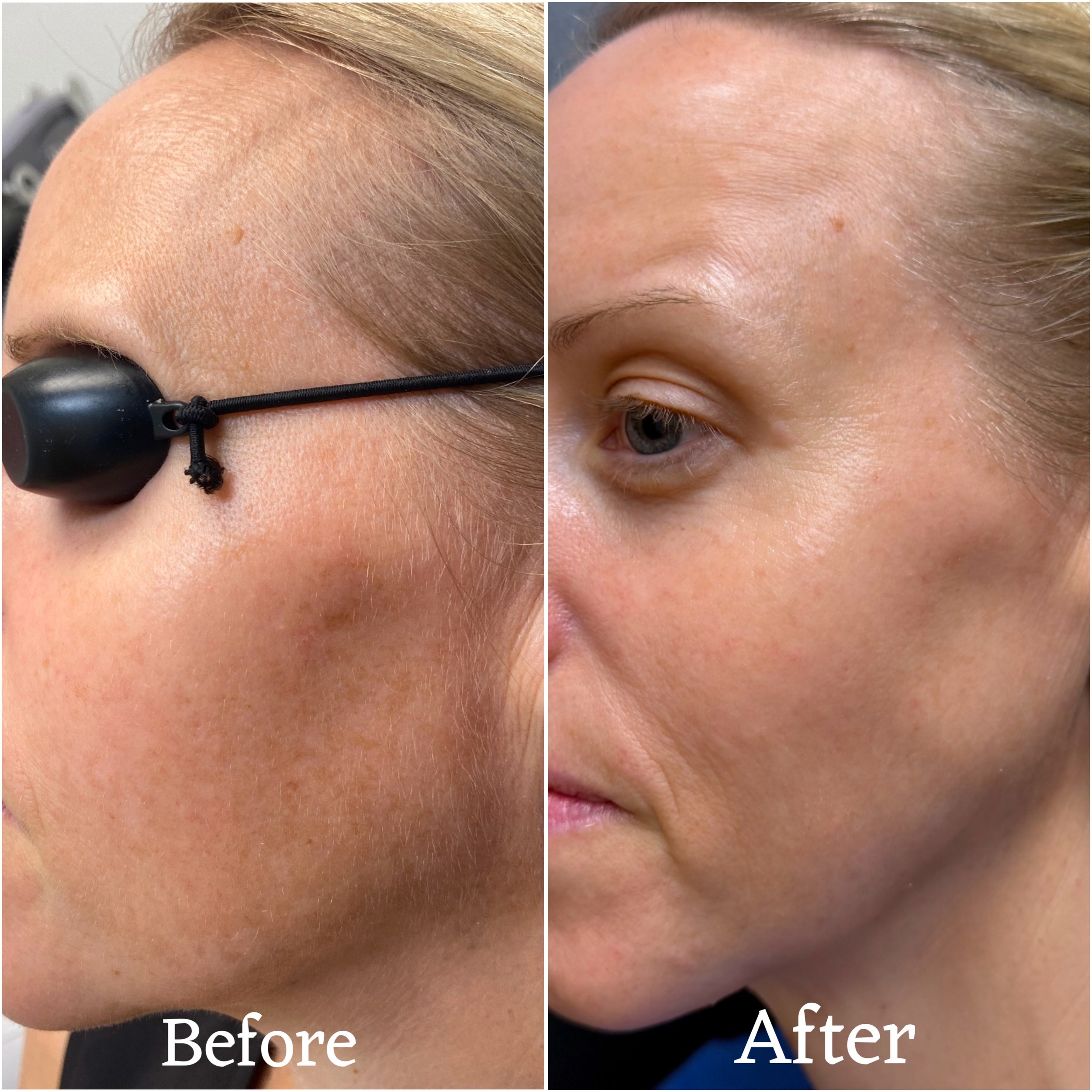 Before and after images showing the removal of facial pigmentation and skin improvement.
