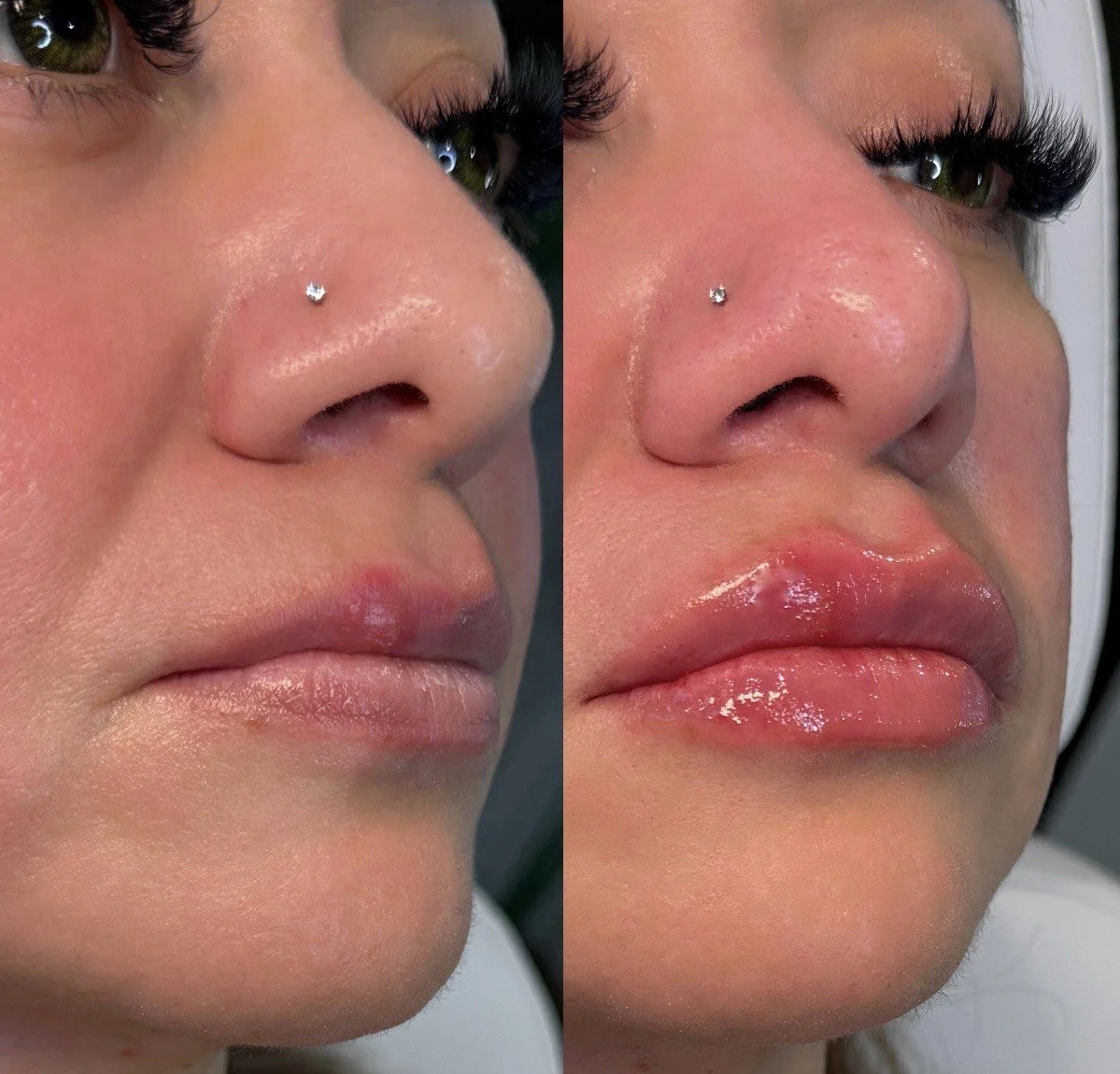 Close-up of a woman's face showing before and after lip enhancement, with glossy, fuller lips on the right.