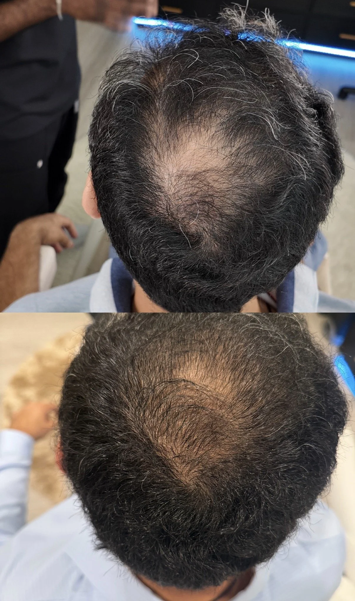 Top view of a man's scalp showing hair thinning and receding hairline before and after a hair restoration or treatment procedure.