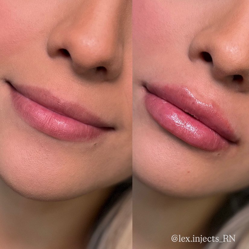 Close-up of a woman's lips and nose before and after lip gloss application, showing smoother and shinier lips on the right