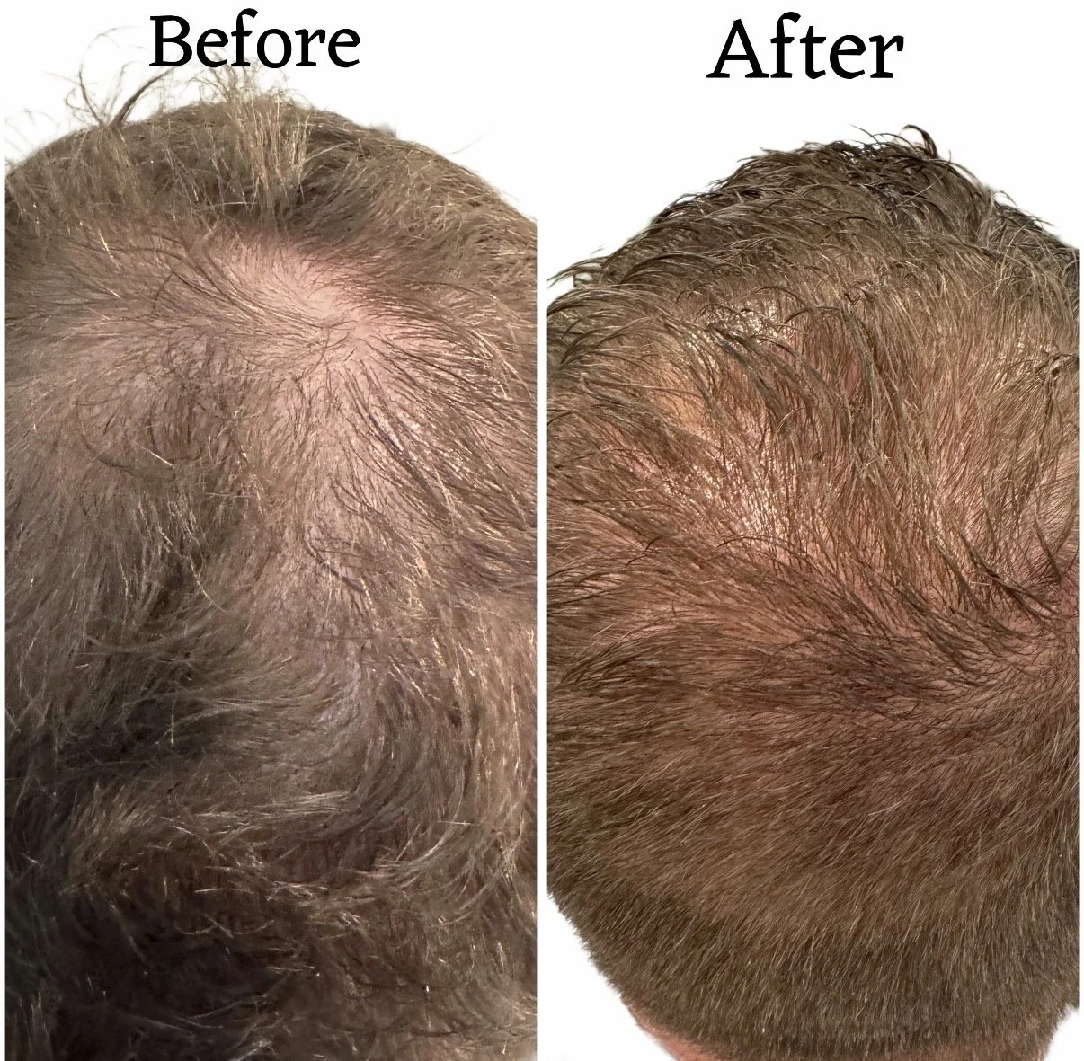 Side-by-side comparison of a person's scalp showing hair loss before and after hair restoration; the left side shows thinning hair, the right side shows thicker hair.