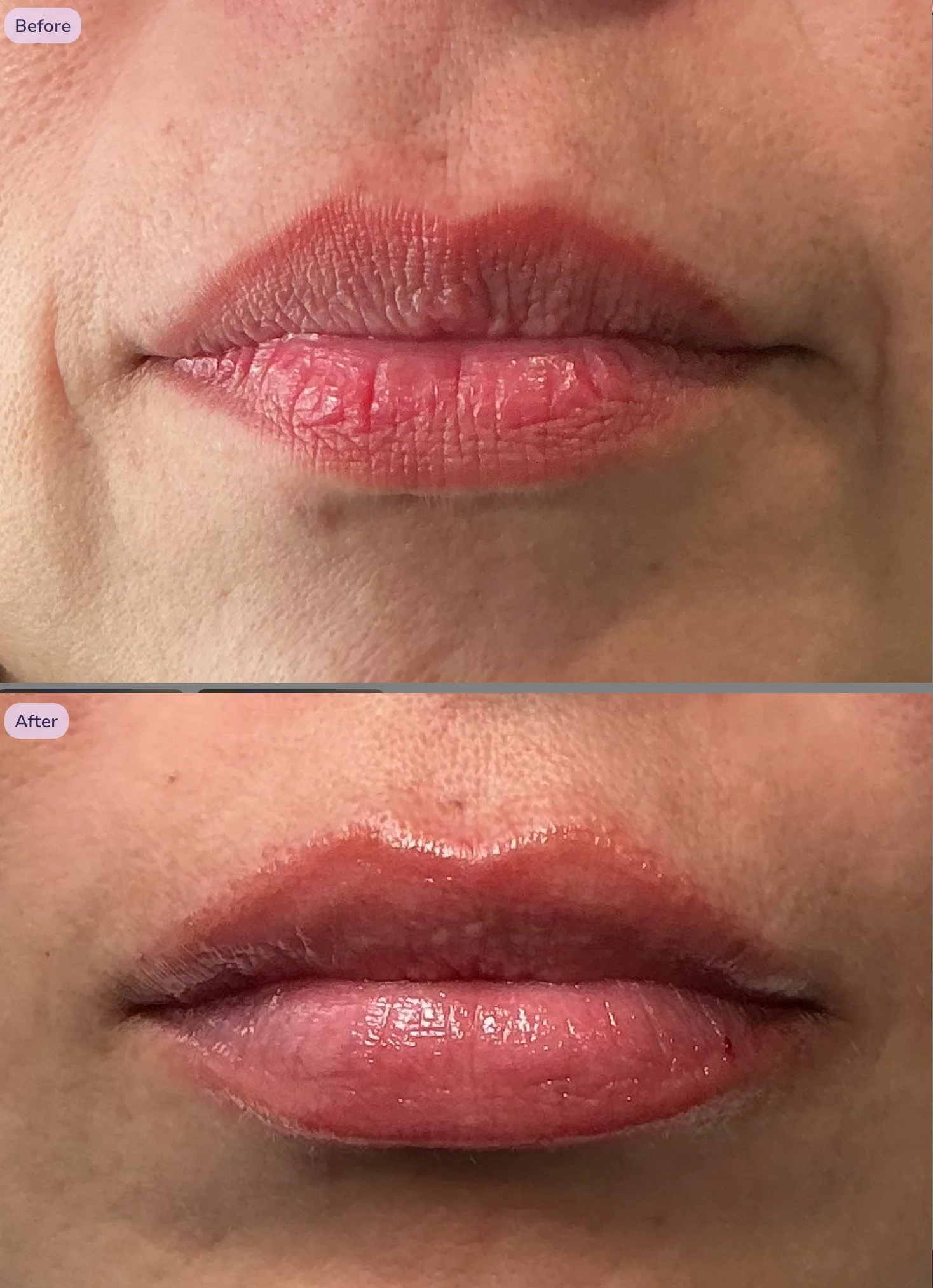 Close-up of a person's lips, showing before and after images of lip treatment or makeup application, with the upper image labeled 'Before' and the lower labeled 'After'.
