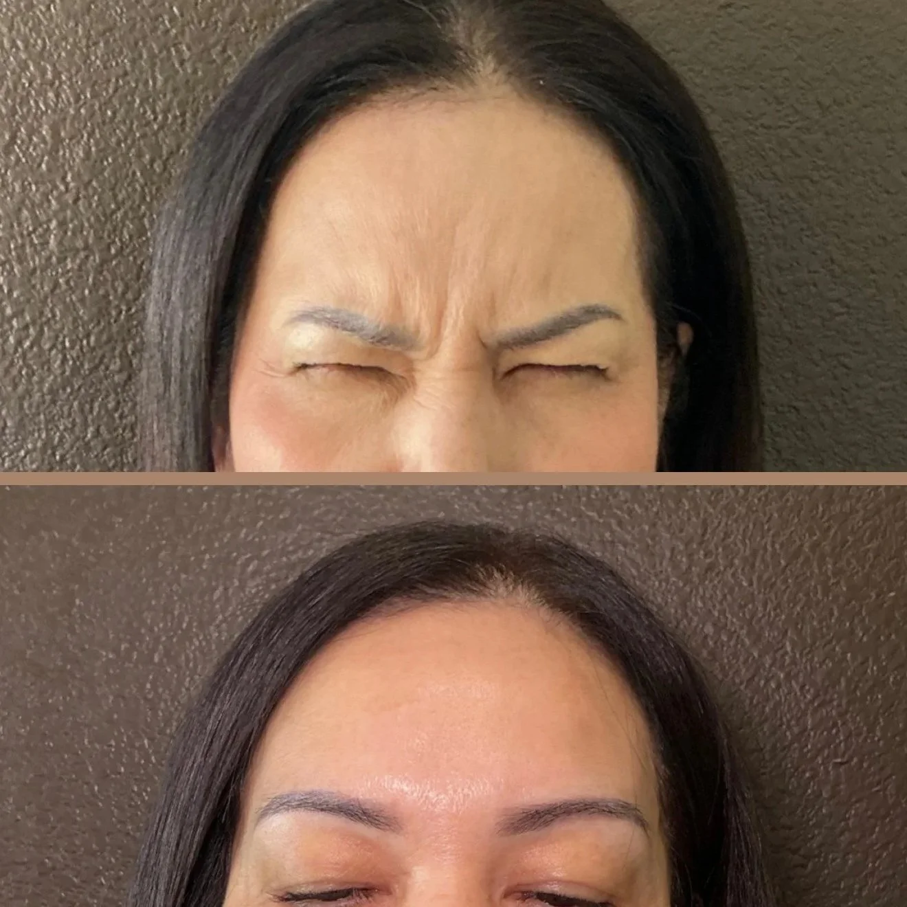 Comparison of a woman's forehead before and after cosmetic treatment showing reduced wrinkles and smoother skin.