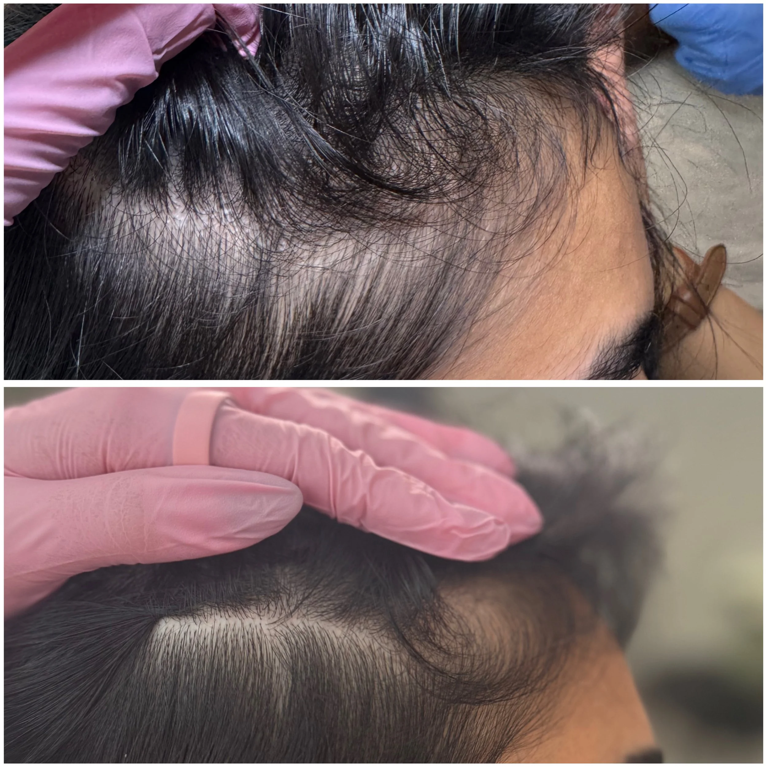 Close-up images of a person's scalp showing before and after hair treatment, with the scalp visibly less scaly and with improved hair density in the after photo, and pink gloves holding the hair in place.