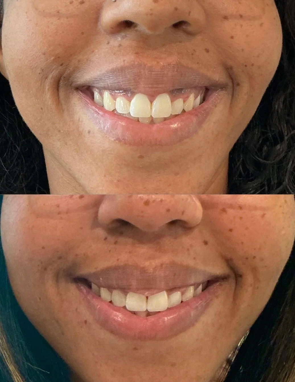 Side-by-side comparison photo of a woman smiling before and after dental treatment, showing improved teeth alignment and appearance.