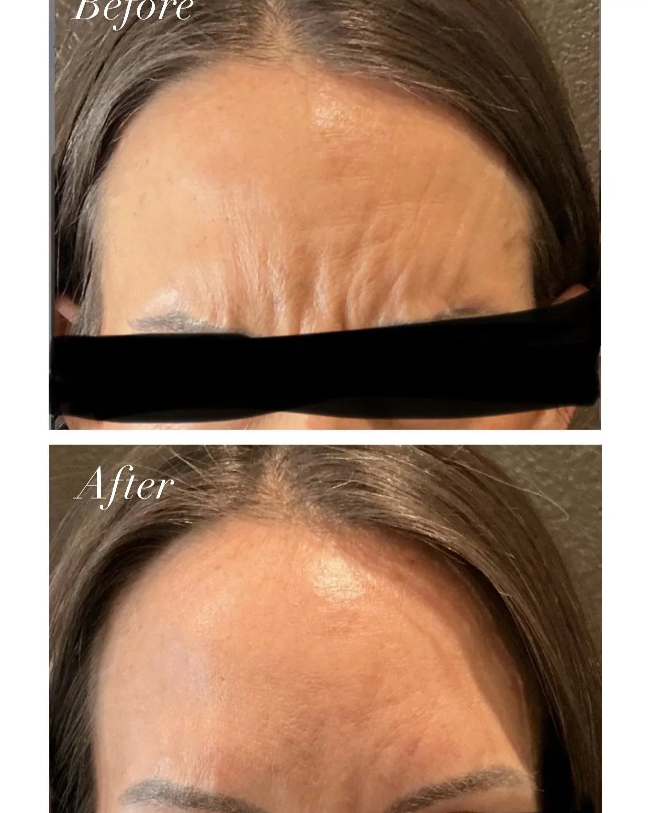 Comparison of forehead wrinkles before and after treatment, showing smoother skin in the "after" image.