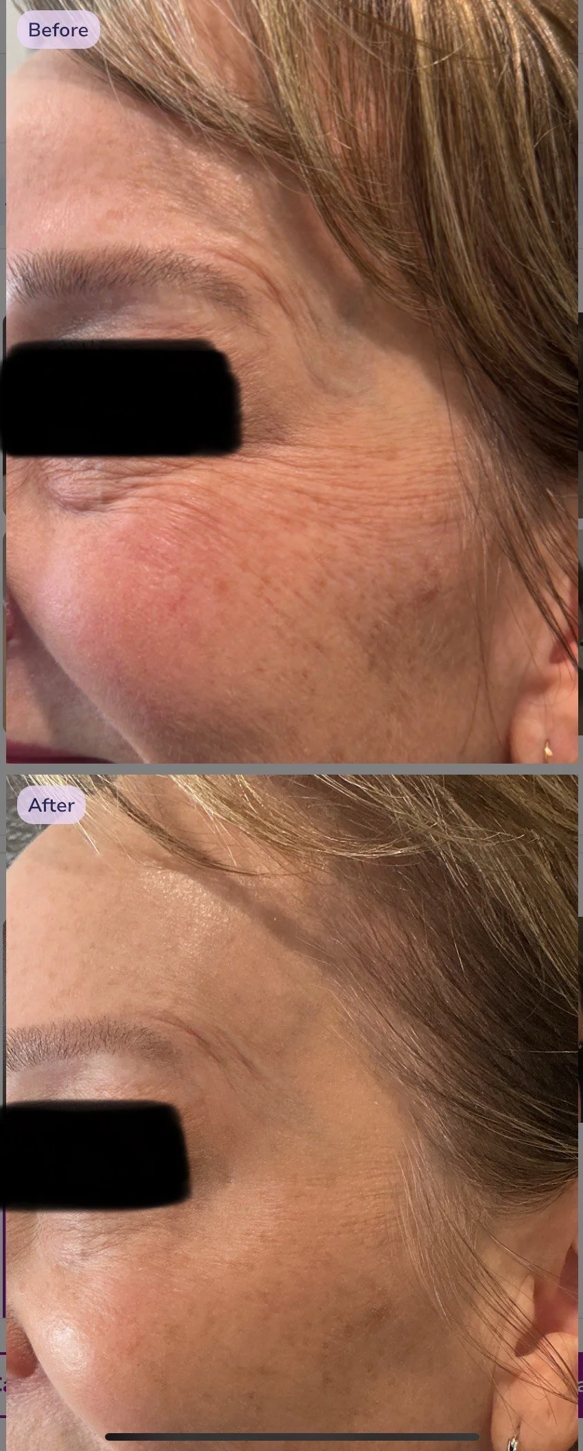 Close-up of a person's cheek and eye area showing before and after skincare treatment results. The 'before' image shows wrinkles and uneven skin texture, while the 'after' image shows smoother, clearer skin with reduced wrinkles.