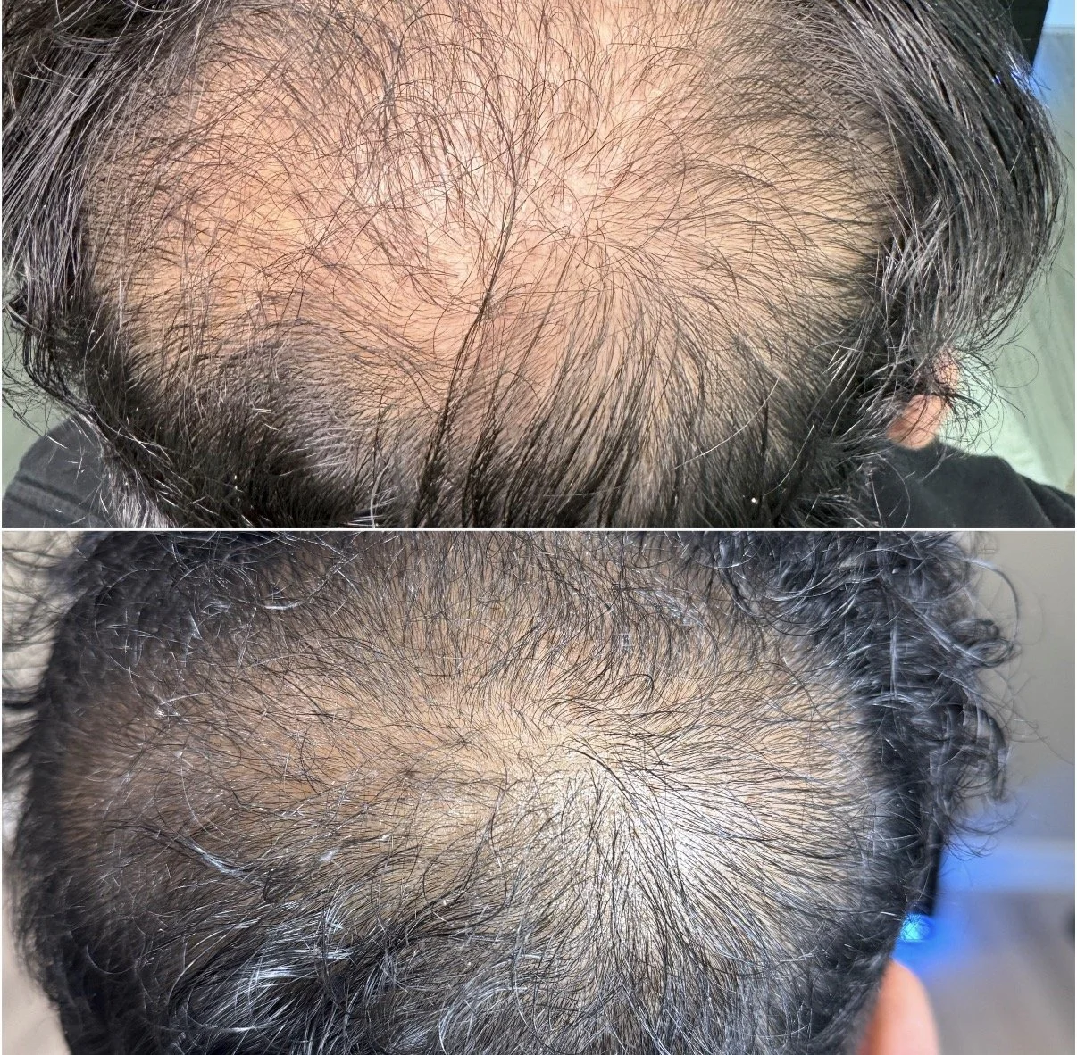 Comparison of a man's scalp showing hair thinning before and after hair restoration treatment, with increased hair density after 3 sessions of ProCell hair restoration.
