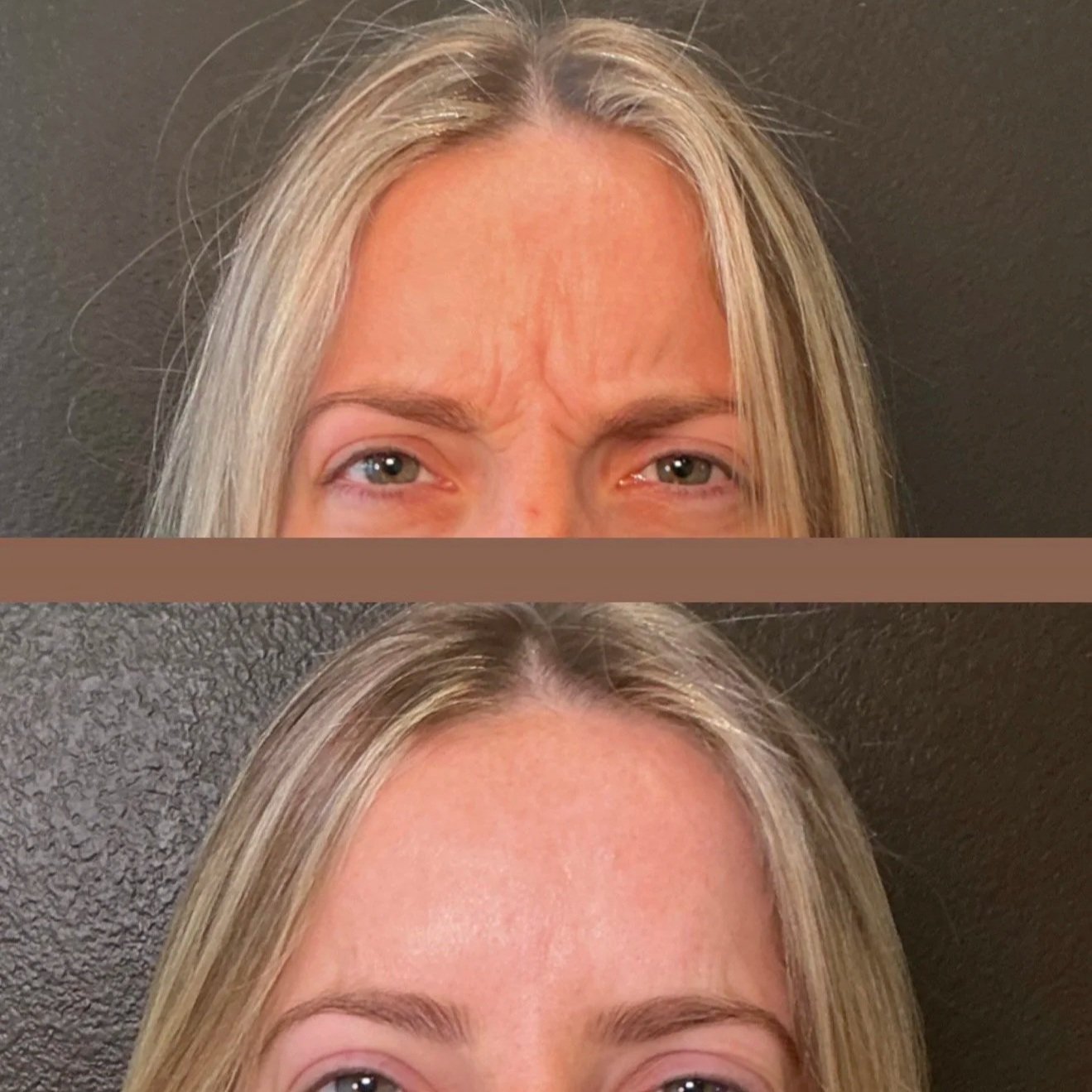 Comparison of a woman's forehead and eyes before and after cosmetic treatment, with the top showing wrinkles and the bottom showing smoother skin.