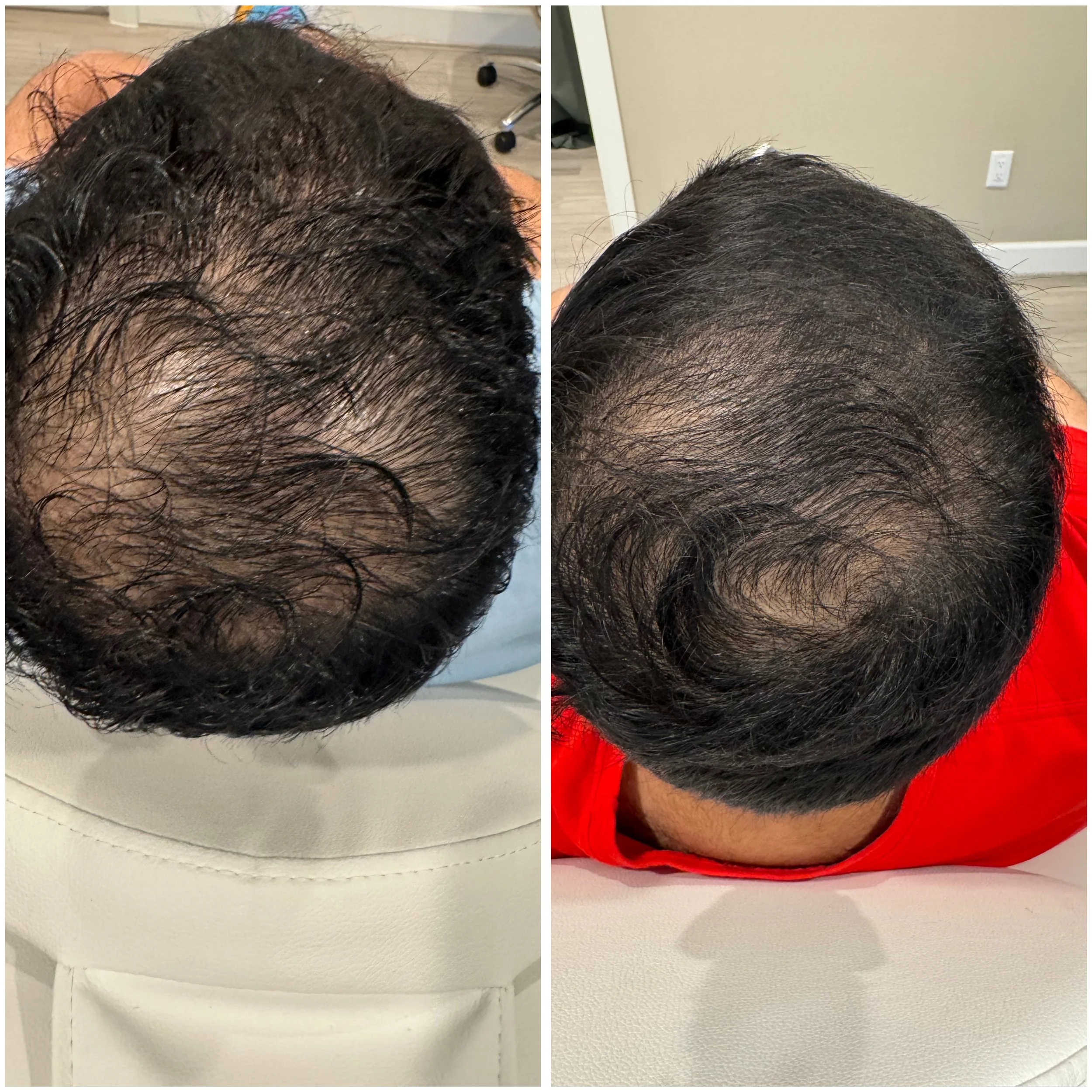 Before and after images showing improvement in hair density on the top of a person's head.