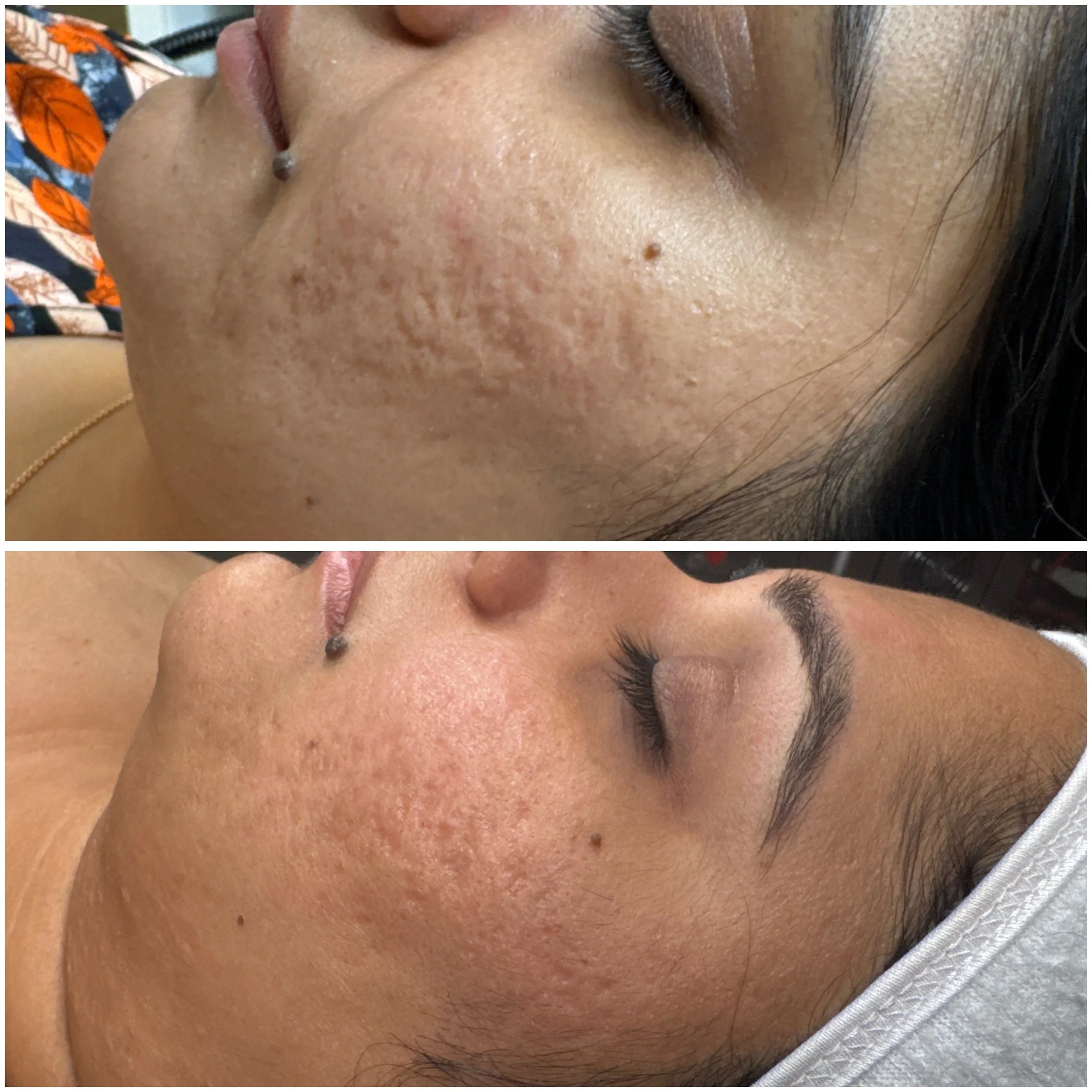 Before and after images of a woman's face showing skin improvement, with the top image displaying acne scars and the bottom image showing smoother skin after treatment.