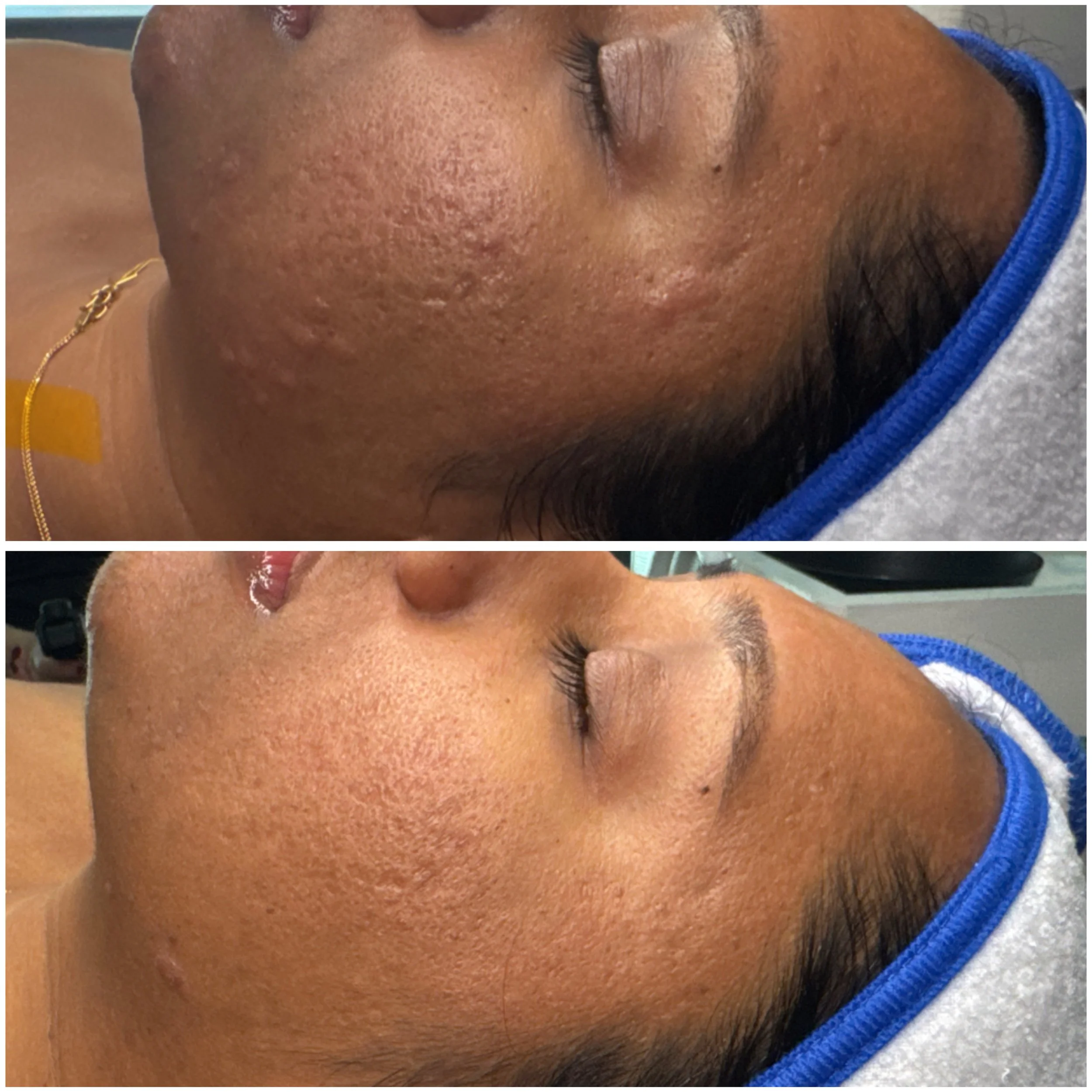 Close-up of a woman's face before and after skin treatment, showing improved skin texture and reduced acne scars.