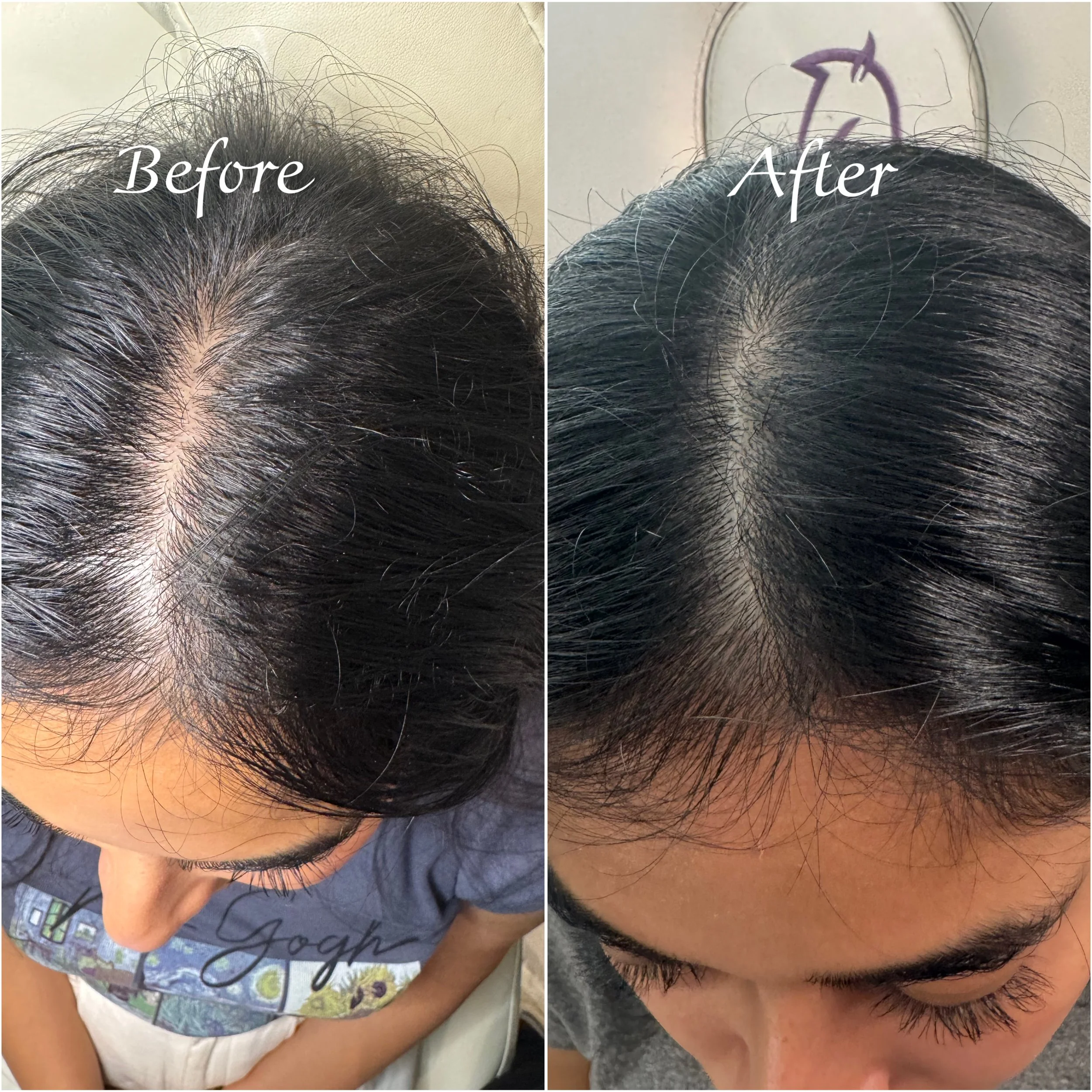 Before and after images of a person's scalp showing improved hair density and coverage after treatment.