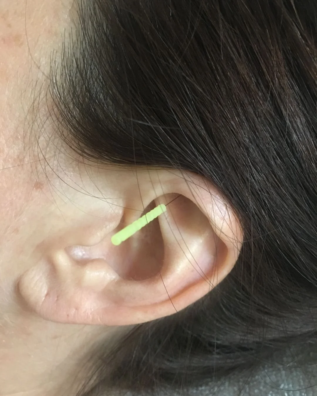 image of acupuncture needle in ear