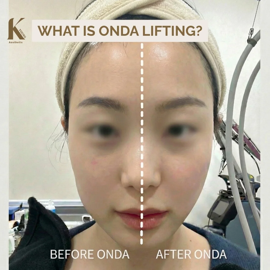 Fat reduction and skin tightening &mdash; done together. ONDA targets deeper fat layers while improving skin elasticity, helping refine your face and body without aggressive pulling or long downtime.
Results build gradually, creating a natural, sculp