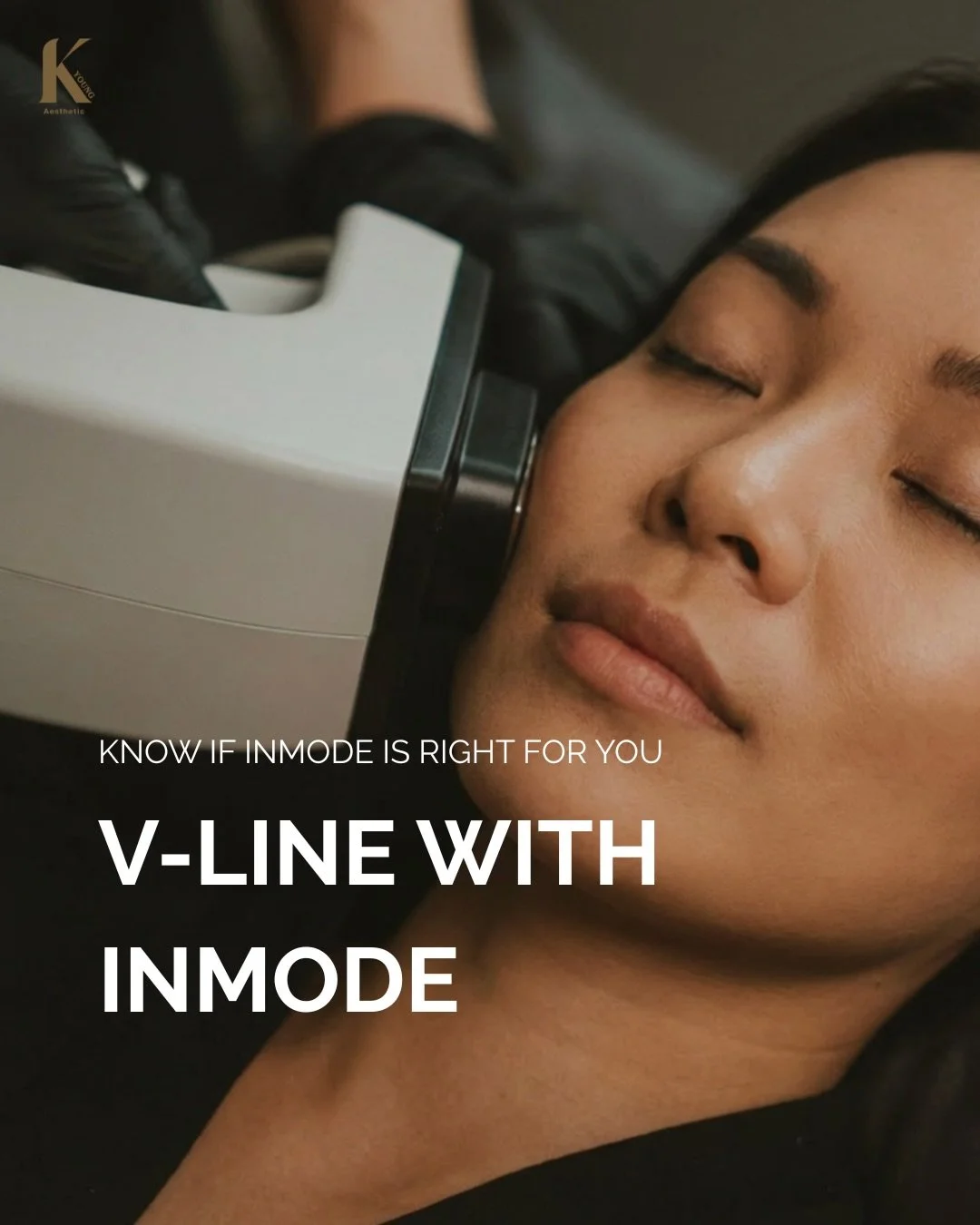 InMode FX is designed to reduce facial fat and refine contours &mdash; not just tighten the skin.
It works best when fat volume is the main cause of a blurred jawline or heavier lower face.
The key to great results is choosing the right mode, the rig