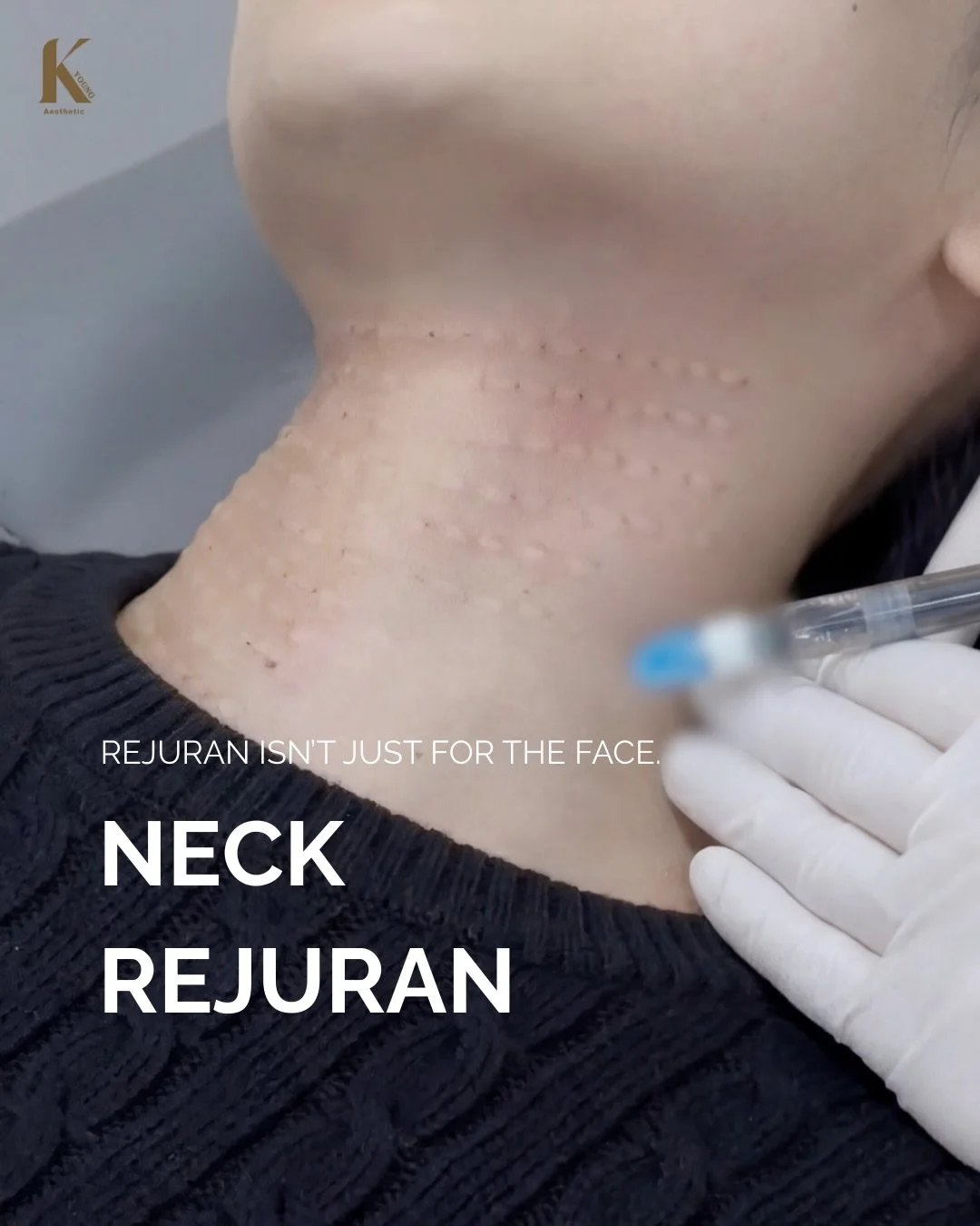 Your face can lie about your age.
Your neck never does.

Rejuran is ideal for fine wrinkles and thinning neck skin that has lost elasticity.
By strengthening skin quality, it helps prevent fine lines from turning into deeper wrinkles.

For best resul