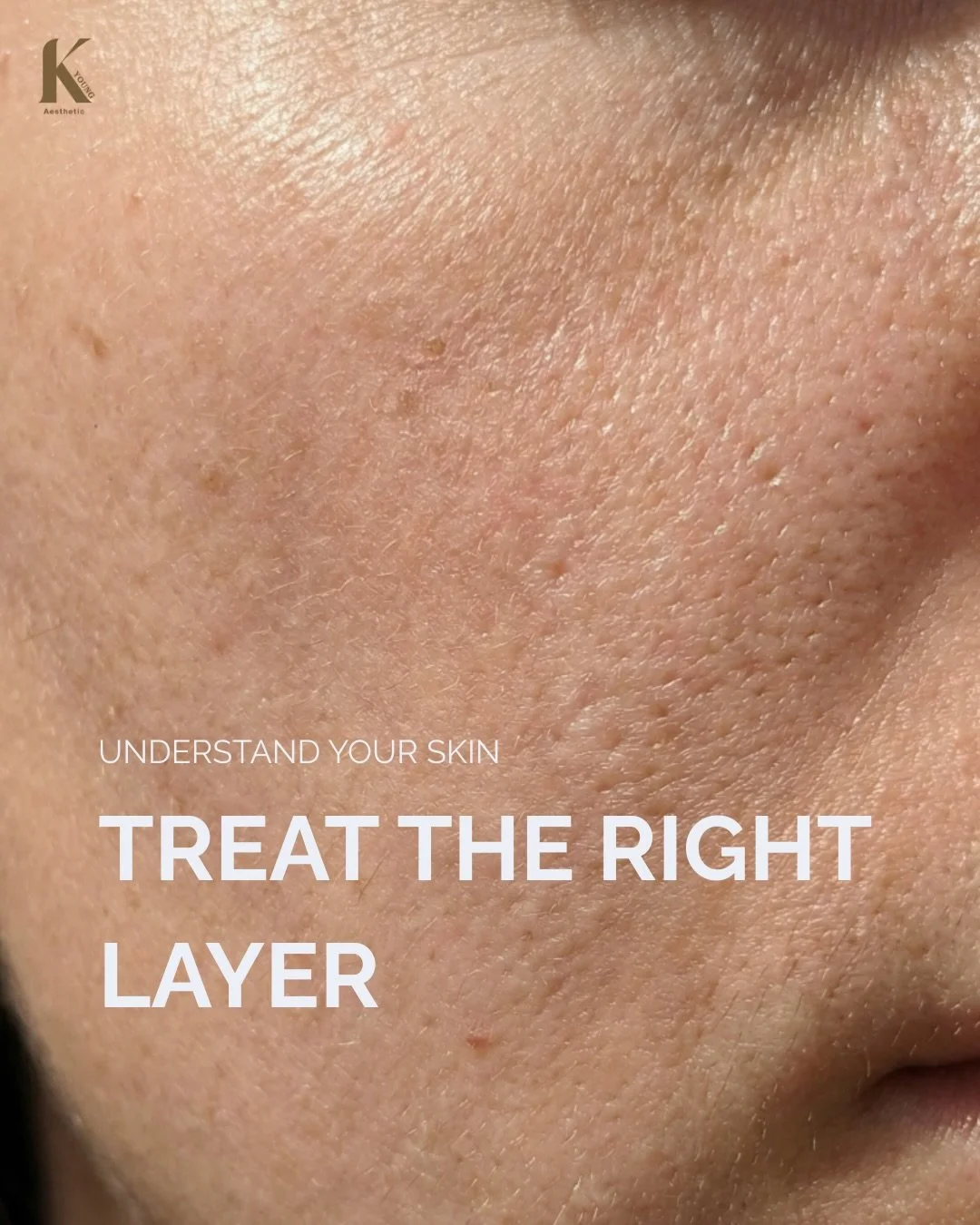Your skin is built in layers &mdash; and each layer needs a different approach.

&bull; Surface (Epidermis): tone, glow, pigmentation
&bull; Middle (Dermis): collagen, pores, fine lines
&bull; Fat layer: volume and facial contour
&bull; SMAS: true li