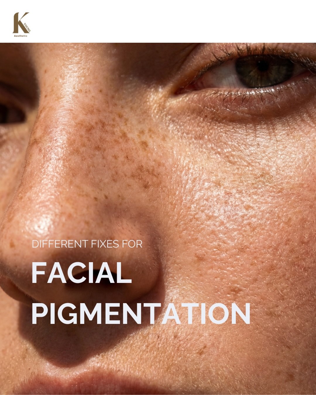 Not all pigmentation responds to the same treatments or skincare.

1️⃣ Melasma
&rarr; Clinic: gentle energy devices, calming ultrasound (LDM), barrier-focused programs
&rarr; Skincare: tranexamic acid, azelaic acid, niacinamide, cica
Avoid aggressive