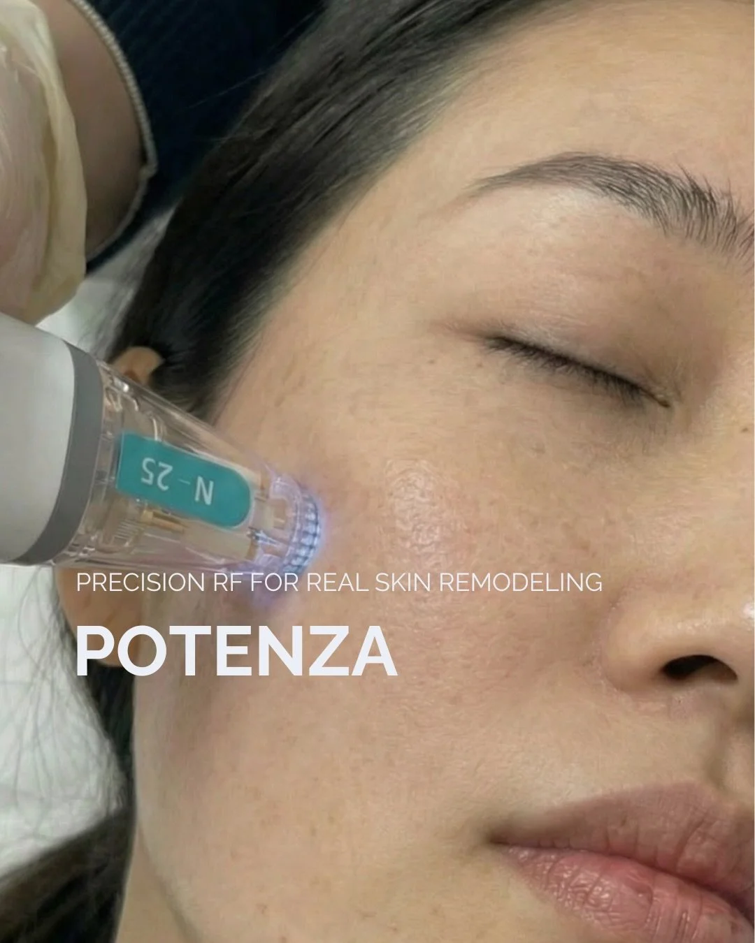 Potenza: Advanced RF Microneedling for Structural Skin Repair
	1.	Structural, not temporary results
Targets the dermal layer to improve skin quality long term.
	2.	Precision RF technology
Delivers controlled energy at exact depths to stimulate collag