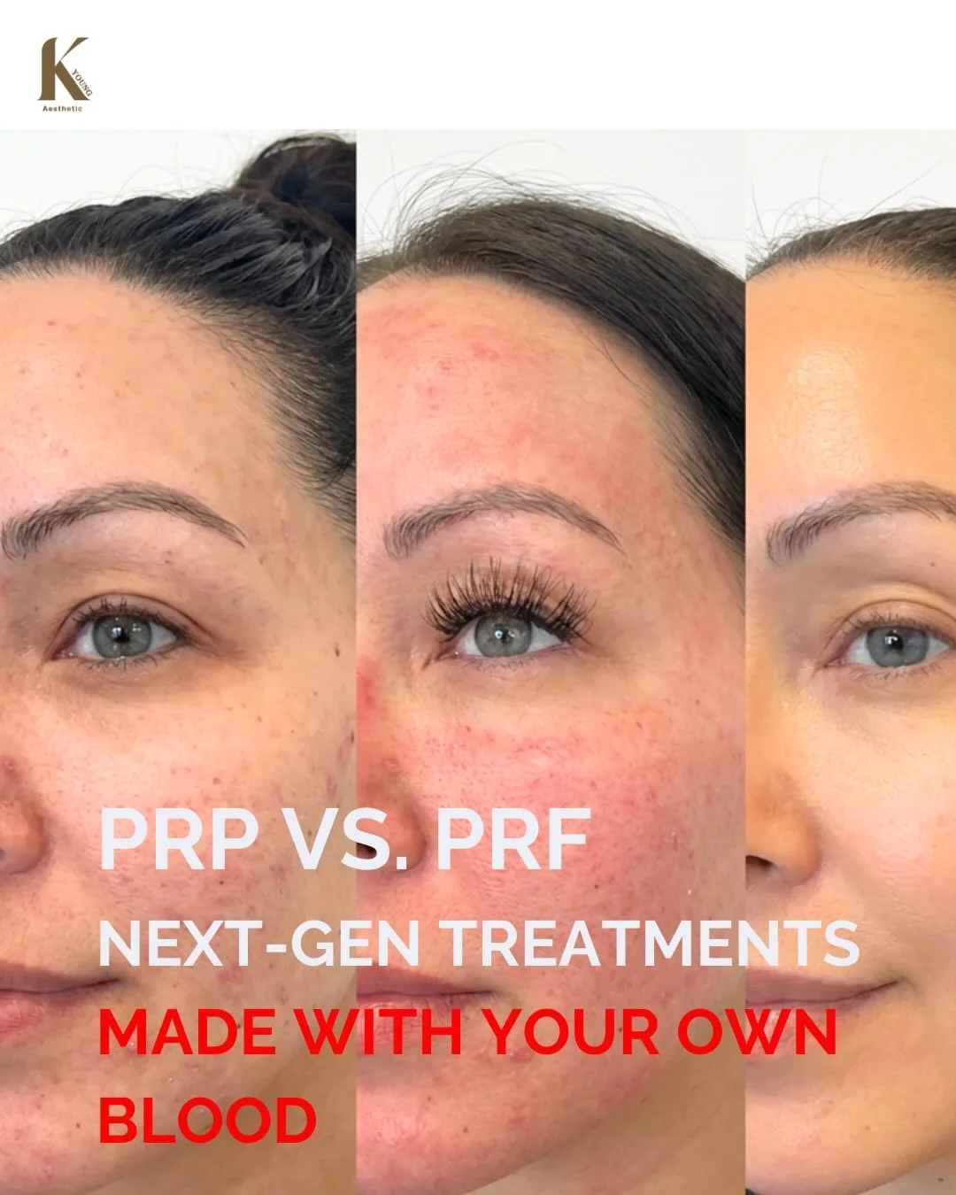 PRP or PRF? One's been around for decades. The other is being called the next-gen skin booster by Korean dermatologists. Here's what you need to know.

PRP หรือ PRF? อันนึงอยู่มานานหลายสิบปี อีกอันถูกเรียกว่า skin booster ยุคใหม่โดยแพทย์ผิวหนังเกาหลี
