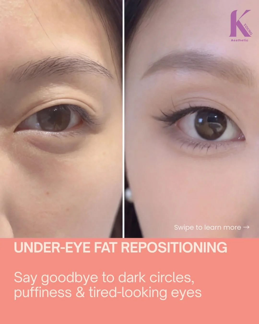 Dark circles? Puffy under-eyes? Looking tired even after a full night's sleep? 👀
Under-eye fat repositioning is a minimally invasive procedure that removes excess fat, fills in hollows, and reinforces the septum &mdash; so it doesn't come back.
You 