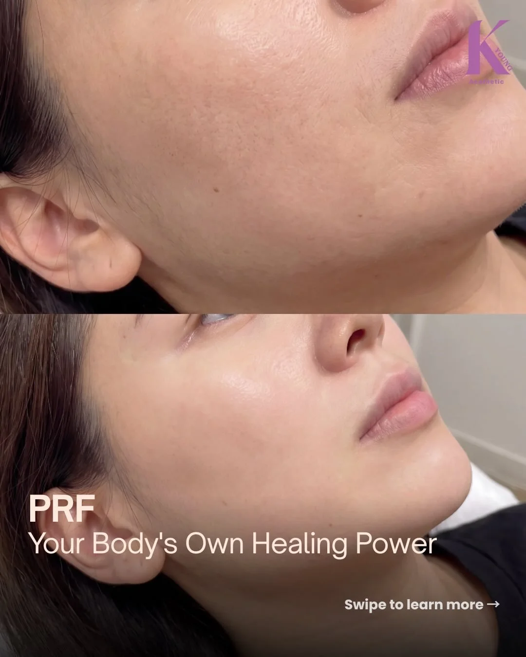 Your body already has the power to heal itself.

PRF (Platelet-Rich Fibrin) uses your own blood to naturally regenerate skin, hair, and tissue &mdash; no fillers, no chemicals.
Swipe to see how it works, who it&rsquo;s for, and what makes next-gen PR
