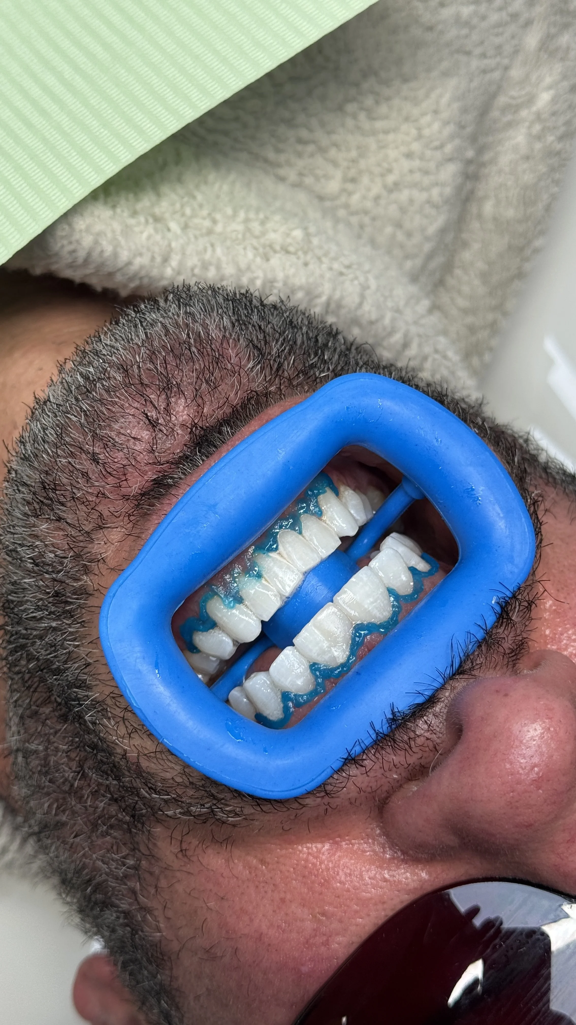 A person's mouth with teeth covered in dental sealant, held open with a blue dental mouth opener at the dentist's office.