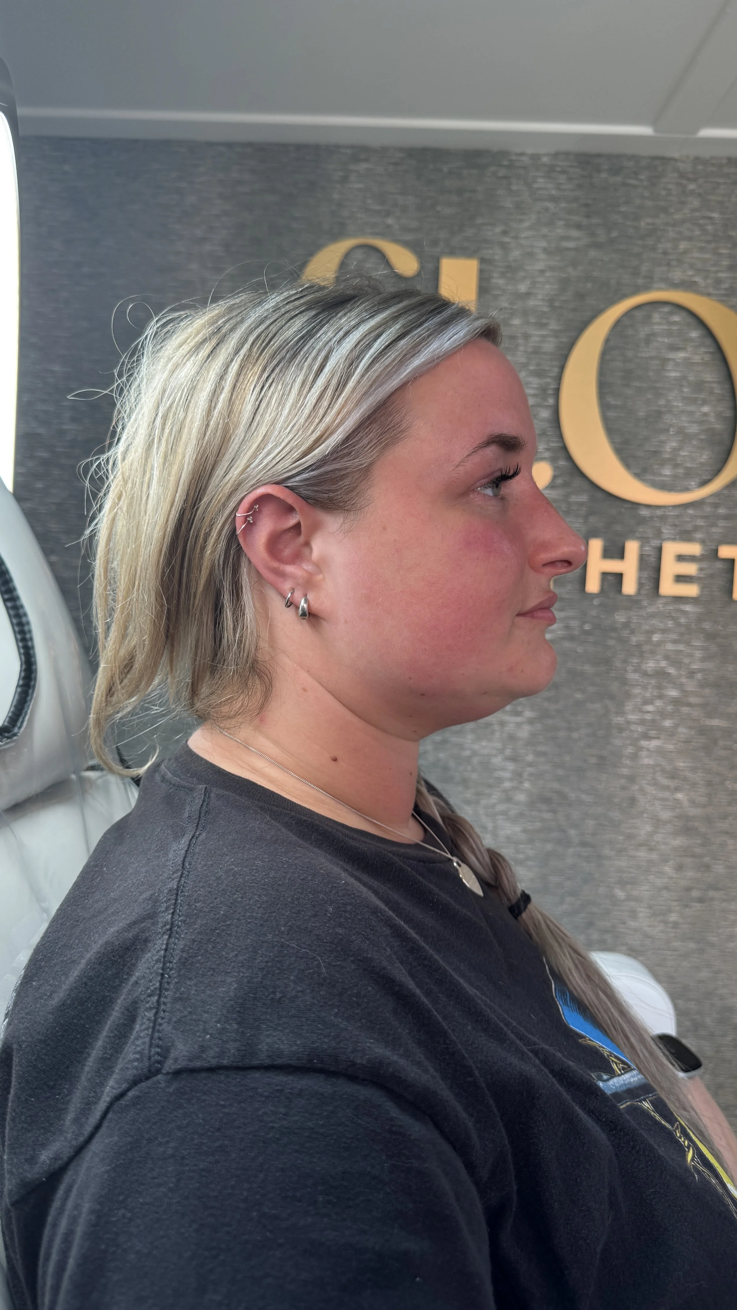 Profile of a woman with blonde hair, wearing earrings and a black shirt, sitting in a dental chair in a dental office.