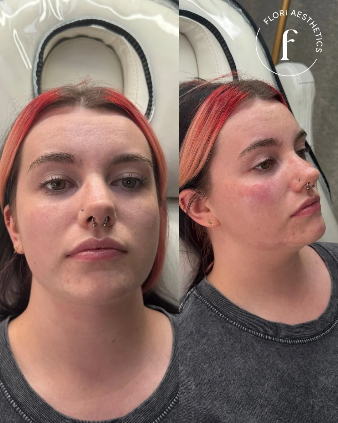 Before and after photos of a woman with colored hair, showing a cosmetic or skincare treatment result at Flori Aesthetics.