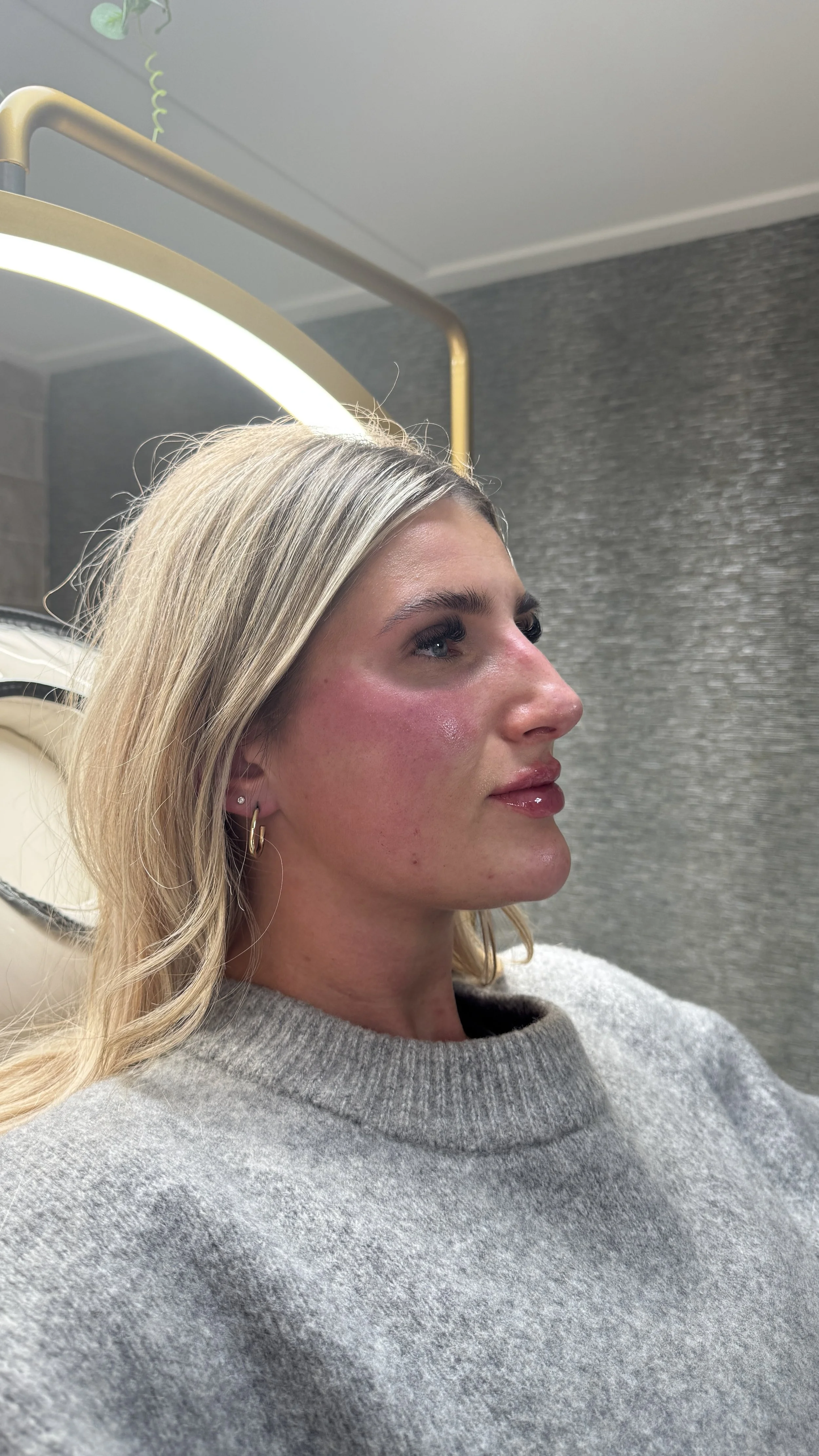 A woman with blonde hair, wearing gold hoop earrings and a gray sweater, sits in a medical or spa setting with a treatment or procedure visible on her face, which has redness and some swelling.
