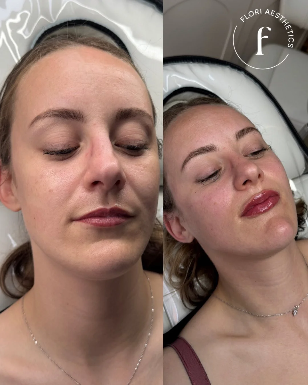 Before and after close-up of a woman's face showing the results of a cosmetic procedure, with her eyes closed in both images.