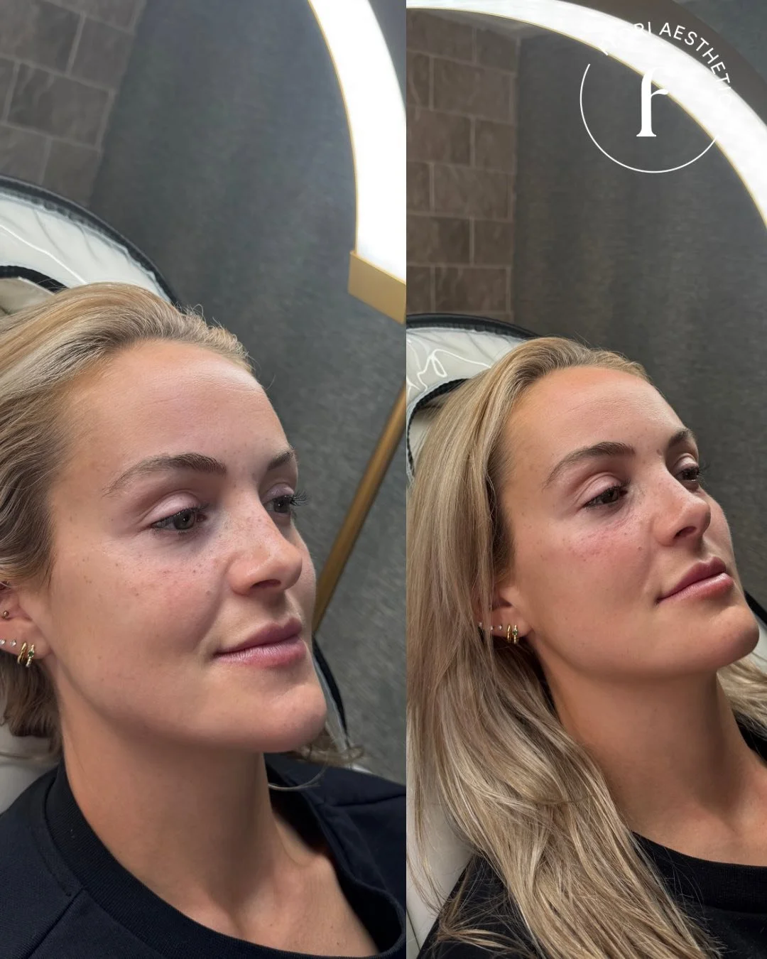 Before and after images of a woman showing a subtle improvement in skin texture and tone, with freckles and blonde hair.